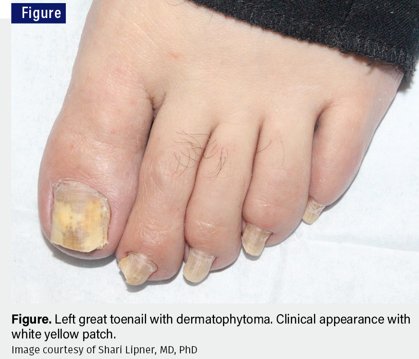 Dermatophytoma: A Diagnosis That You Do Not Want to Miss 