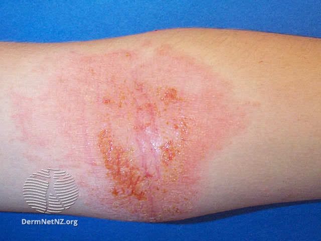 atopic dermatitis |image credit: DermNet