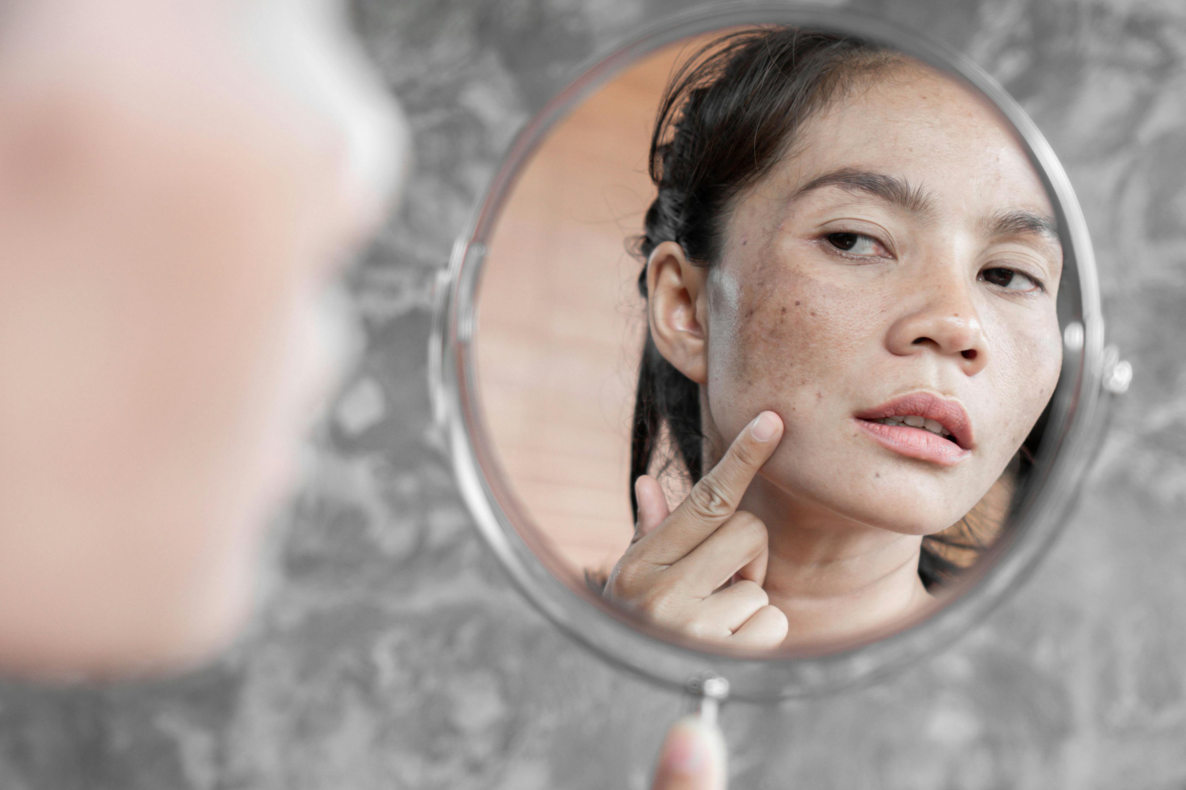 woman with hyperpigmentation looking in a mirror