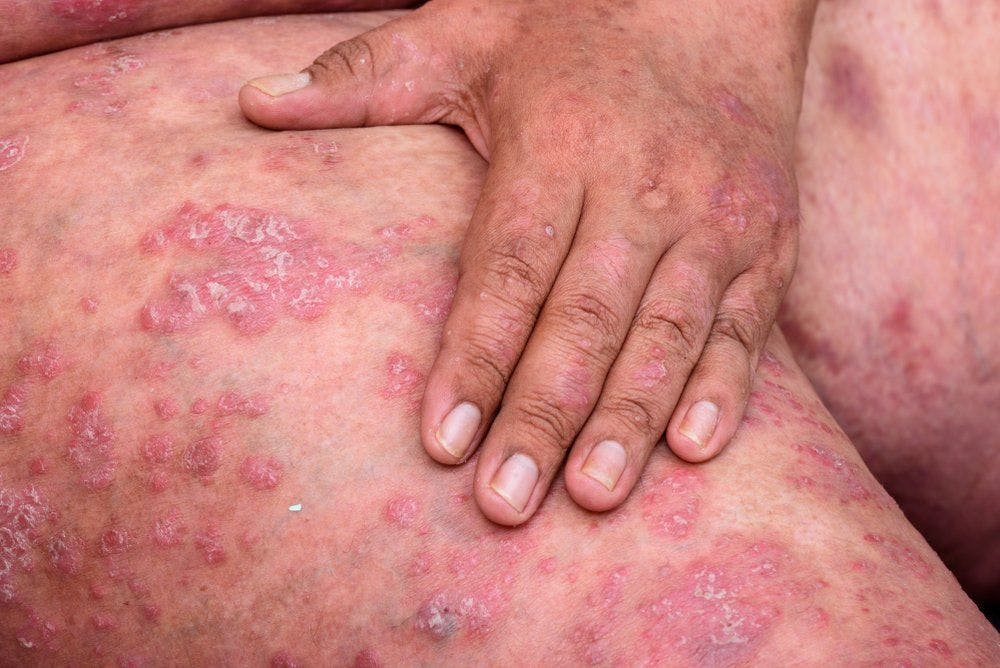 Some psoriasis studies you shouldn't miss