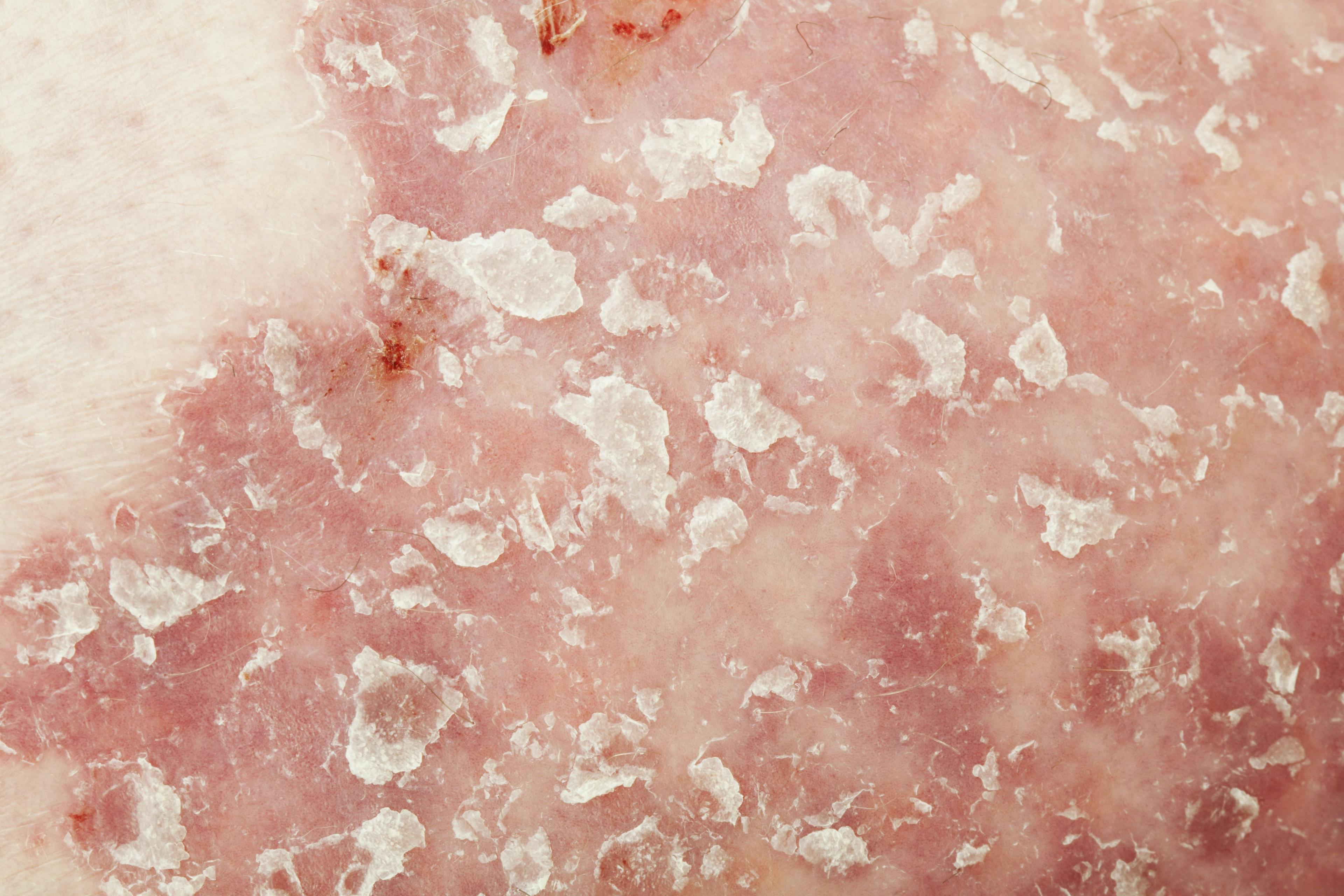 Study: Overlapping Comorbidity Risks Found in Psoriasis and Palmoplantar Pustulosis