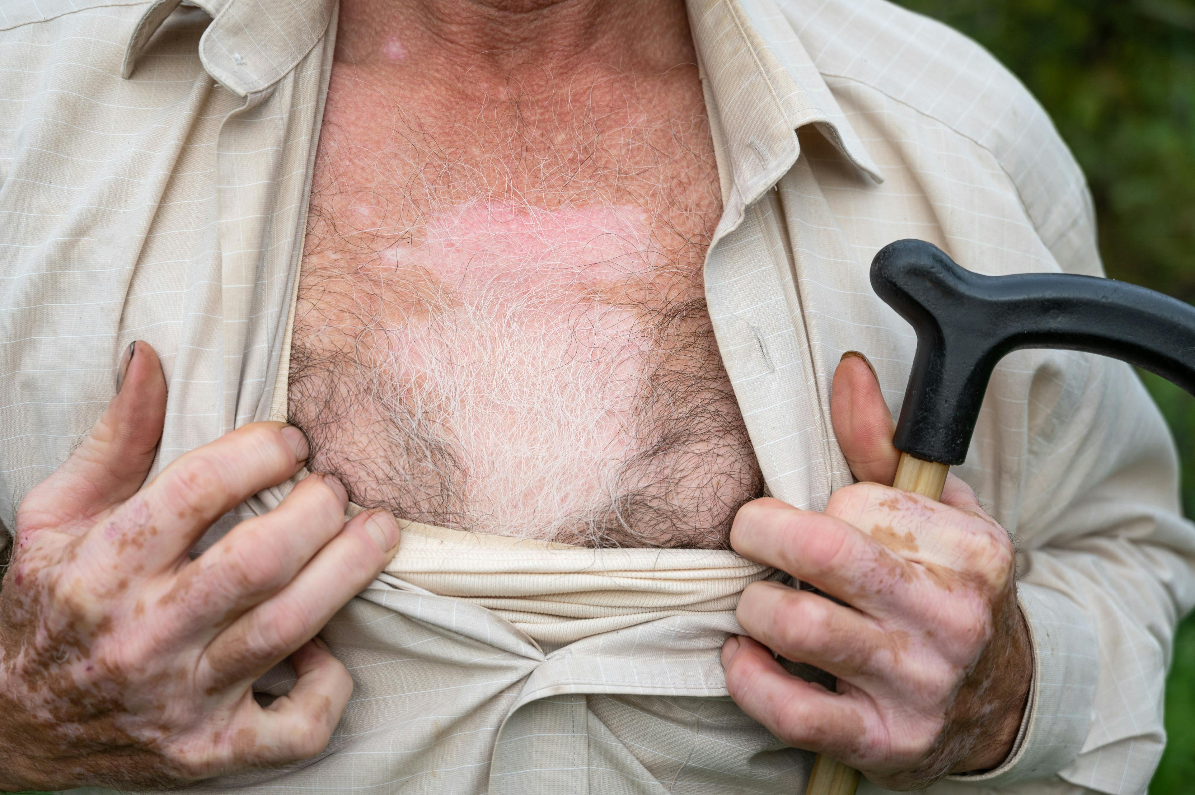Older male with vitiligo on the hands and chest