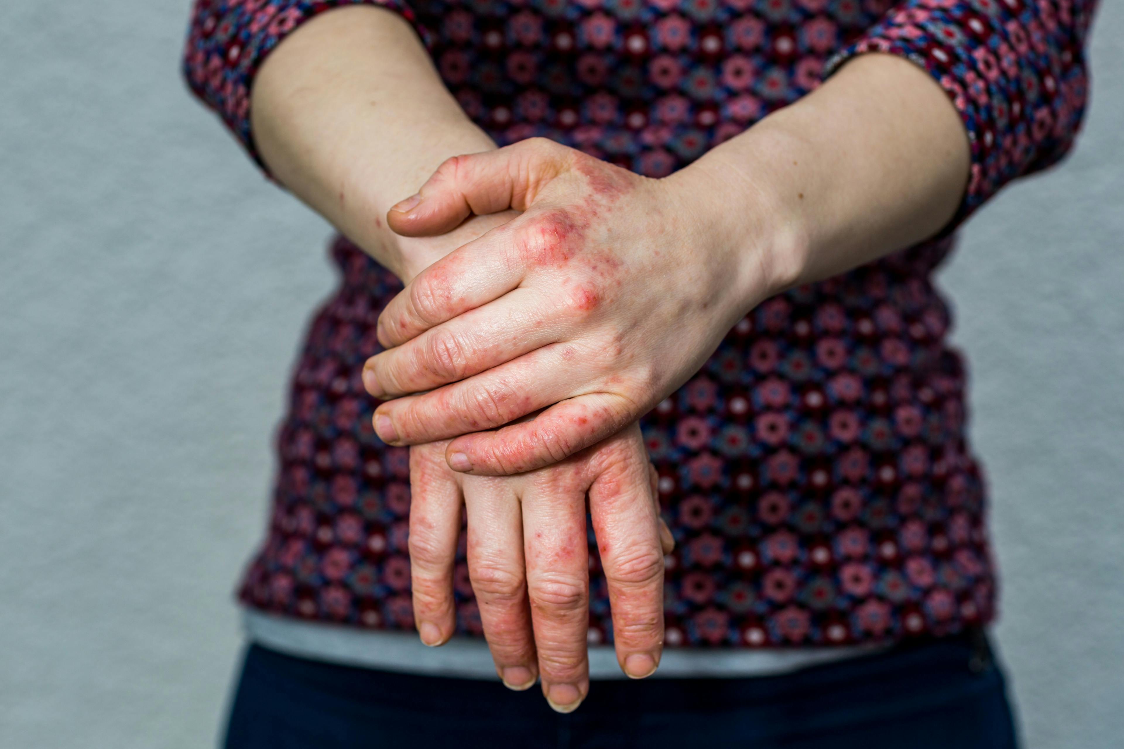 Young woman with eczema covered hands
