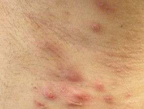 Hidradenitis Suppurativa Diagnosis May Be Predicted and Supported By Machine Learning Model 