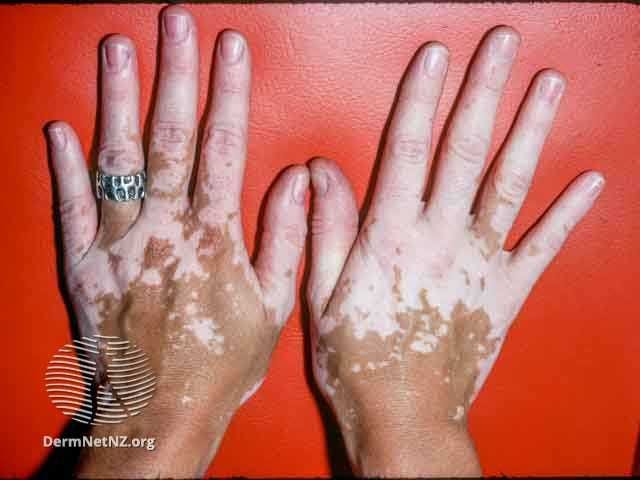 Vitiligo of the fingers and dorsal hands | Image credit: © DermNet