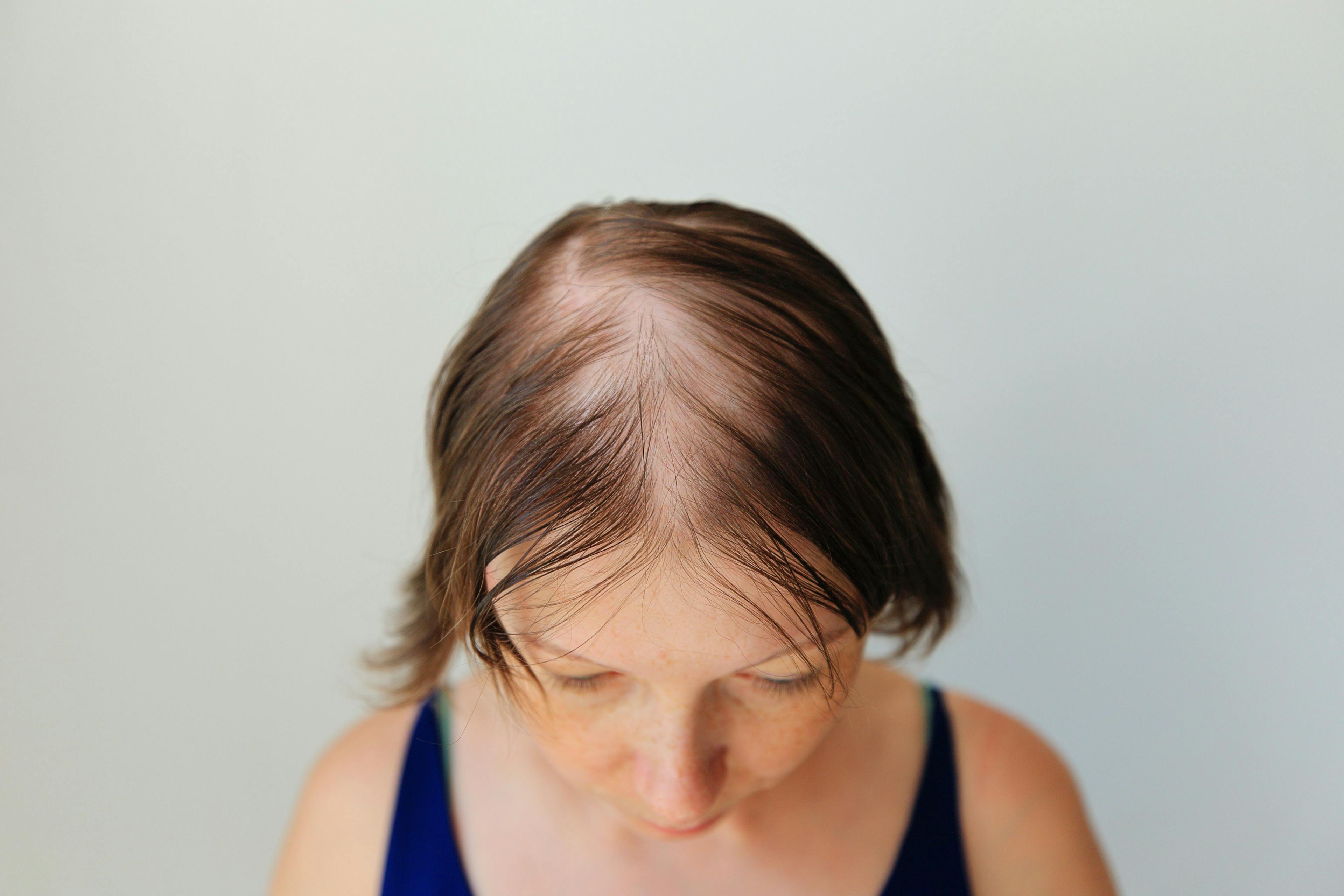Uptitration of Baricitinib Effective in Improving Hair Growth in Patients With Alopecia Areata