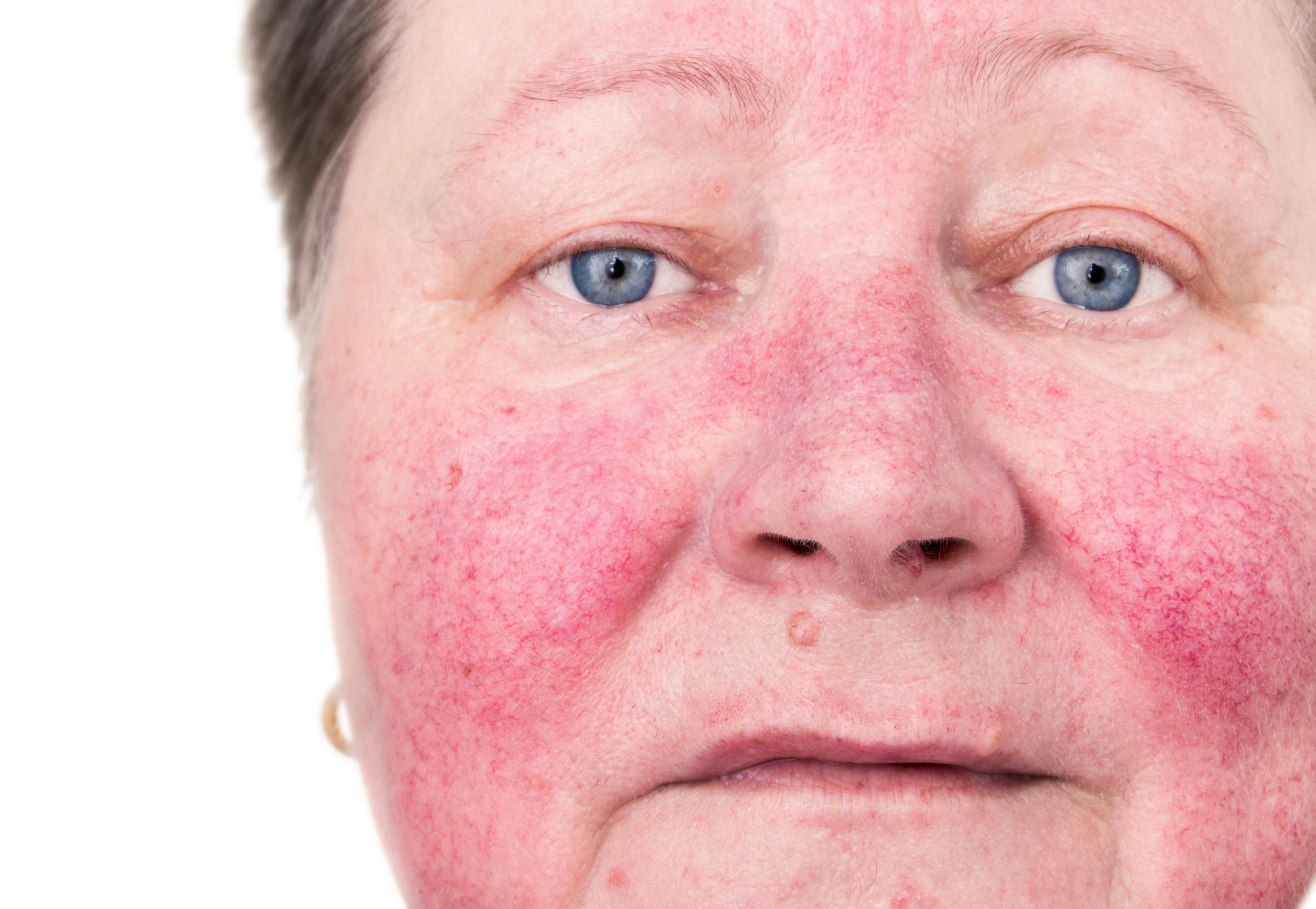 Woman with rosacea on the cheeks