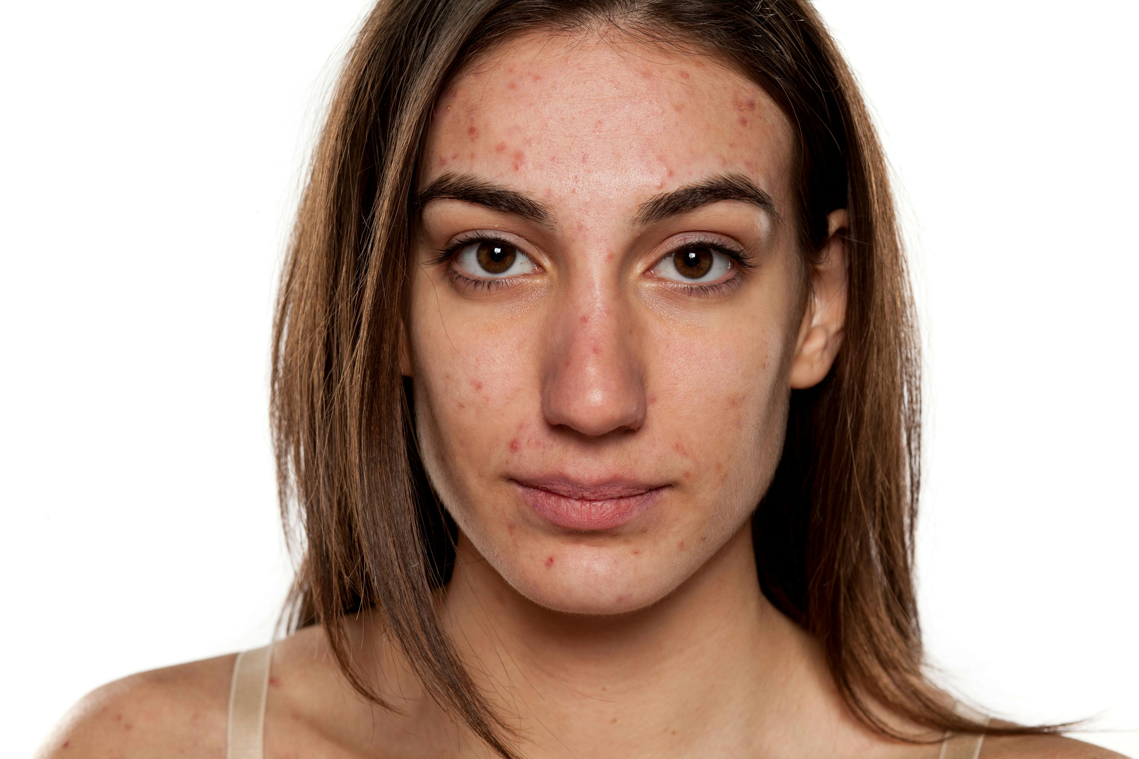 How to Effectively Manage Acne in Women With Spironolactone and Oral Contraceptives 
