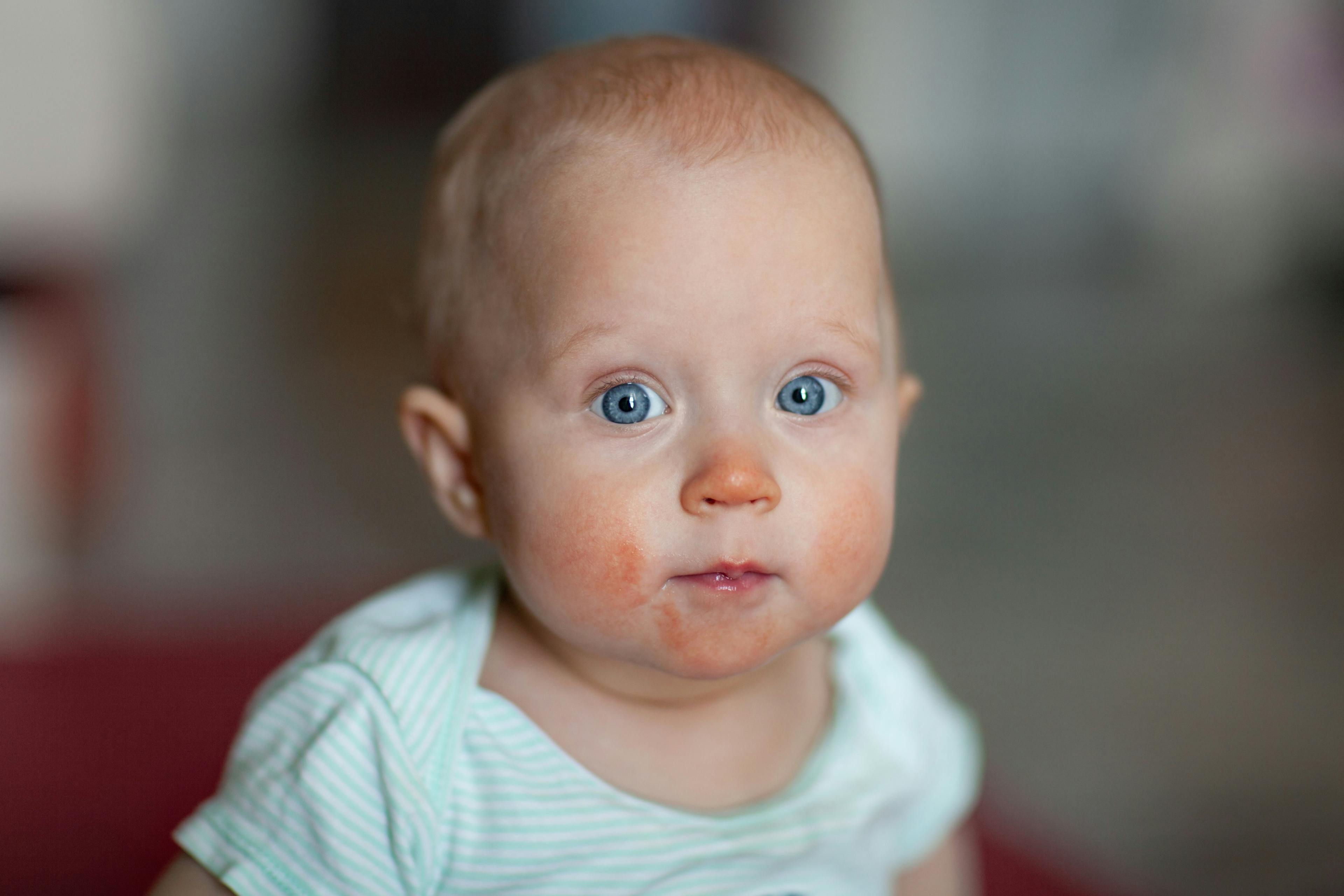 Skin Swab Analysis Reveals Early Predictors of Atopic Dermatitis in Infants