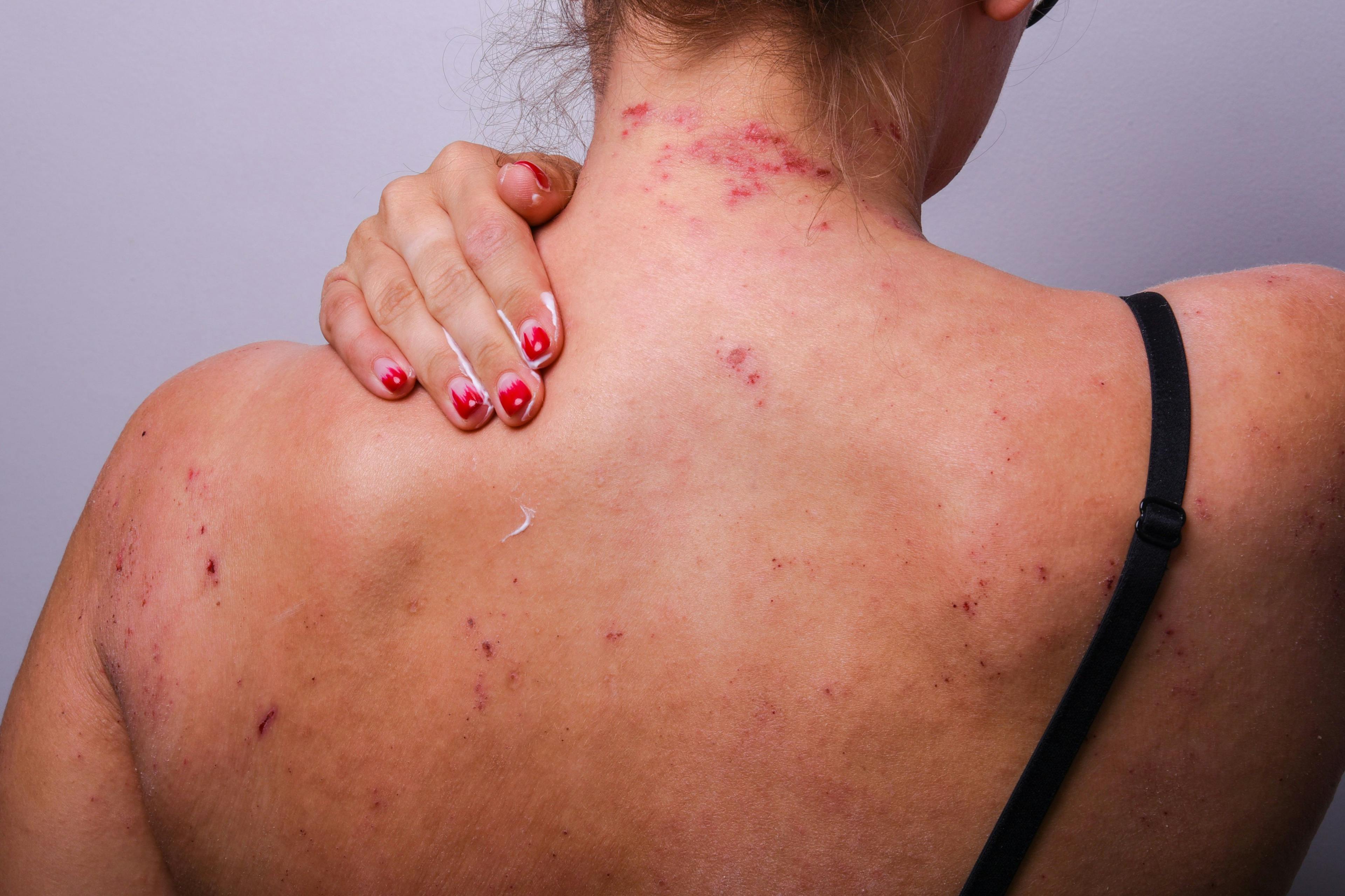 Psychological Stress Exacerbates Brain Activities in Female Patients With Atopic Dermatitis