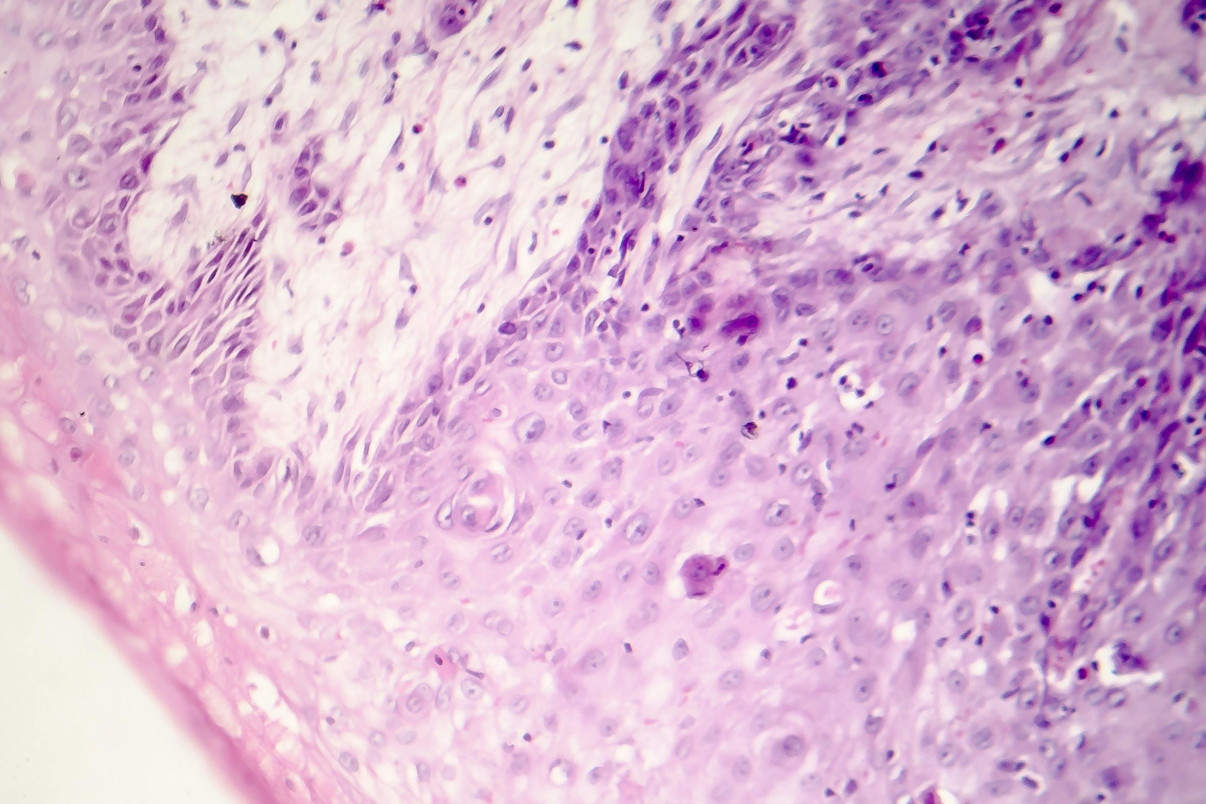 close up of squamous cell carcinoma tumor