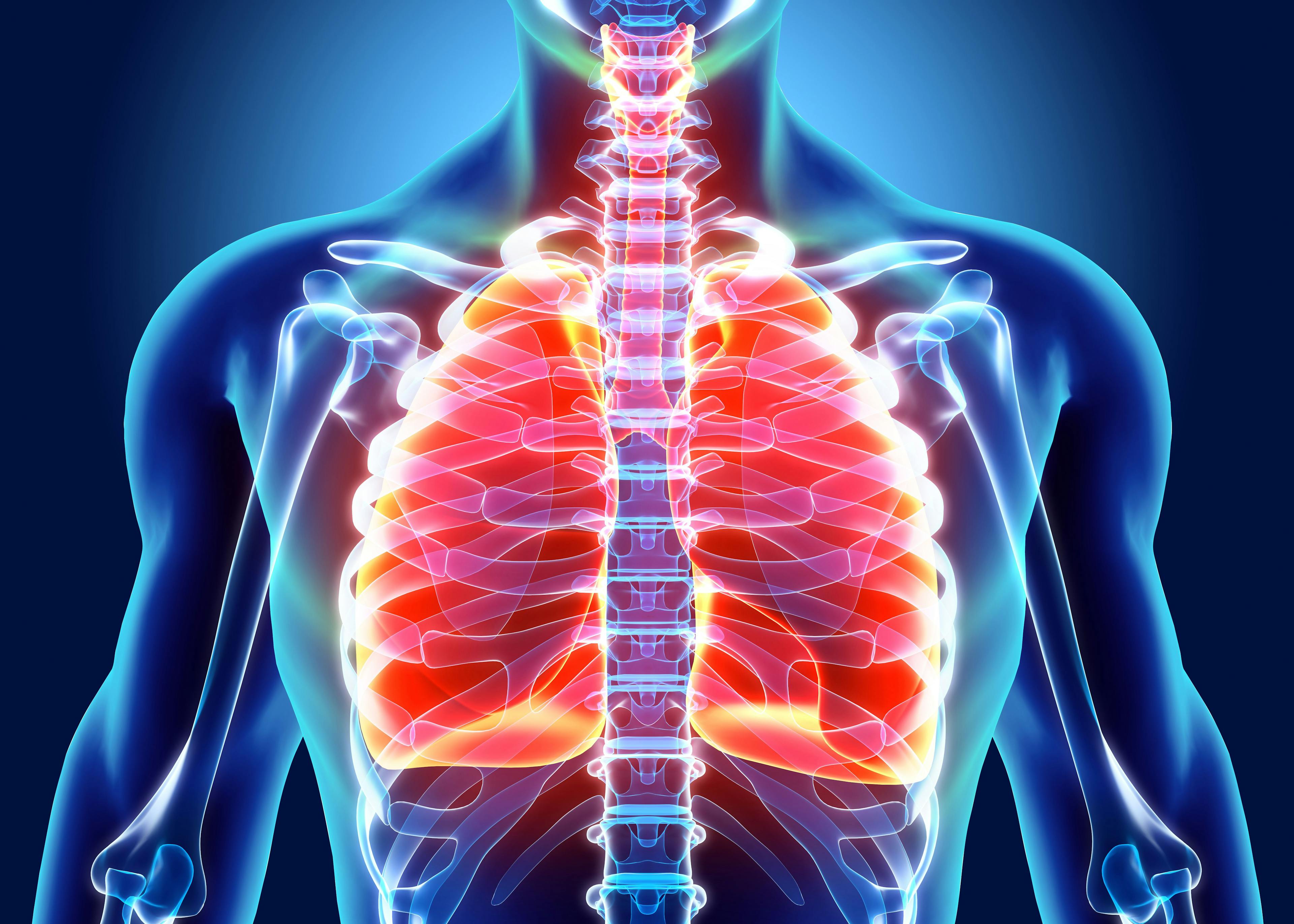 Patients With Hidradenitis Suppurativa Have Increased Odds of Respiratory Disease, According to Study Findings