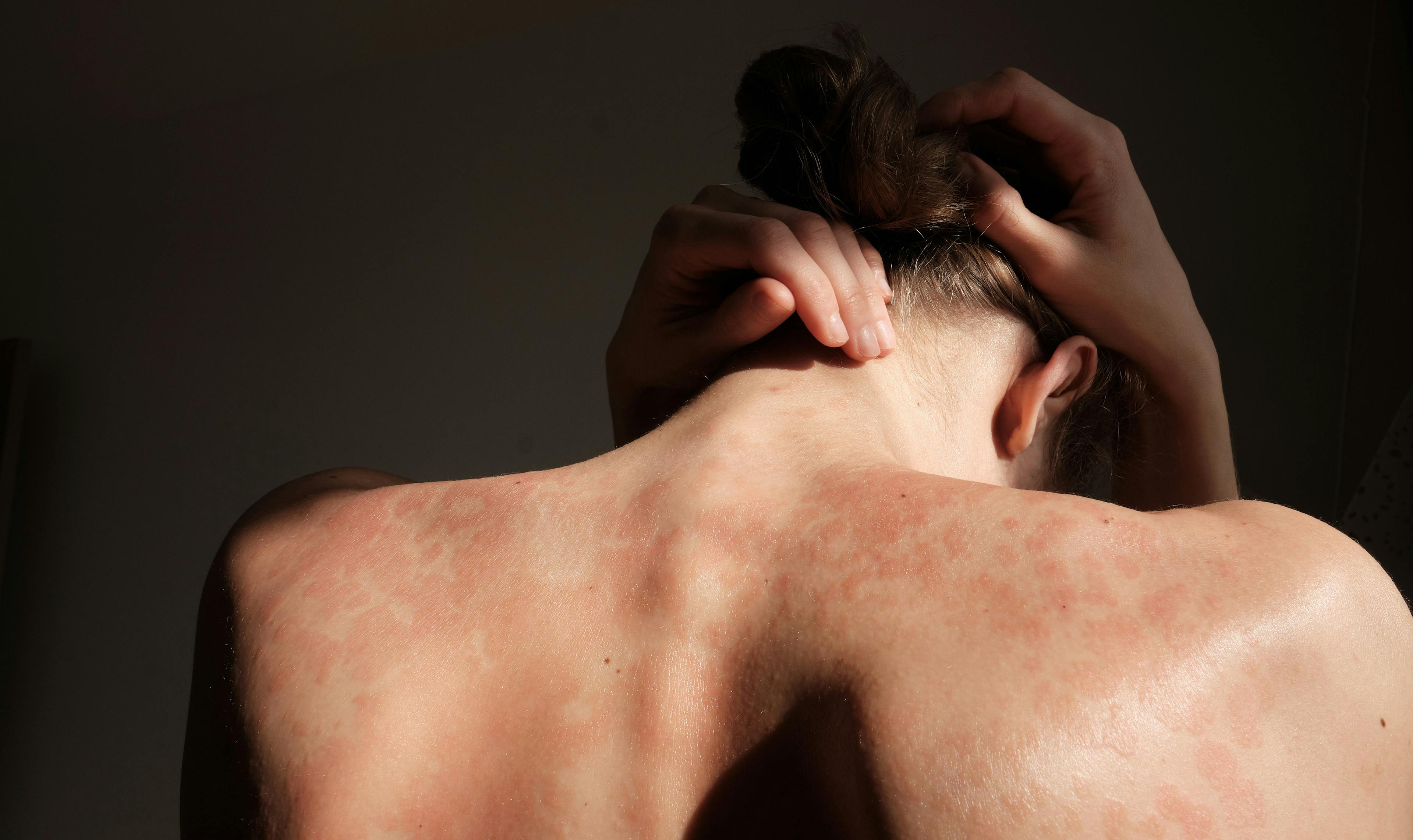 Woman with psoriasis on the upper back