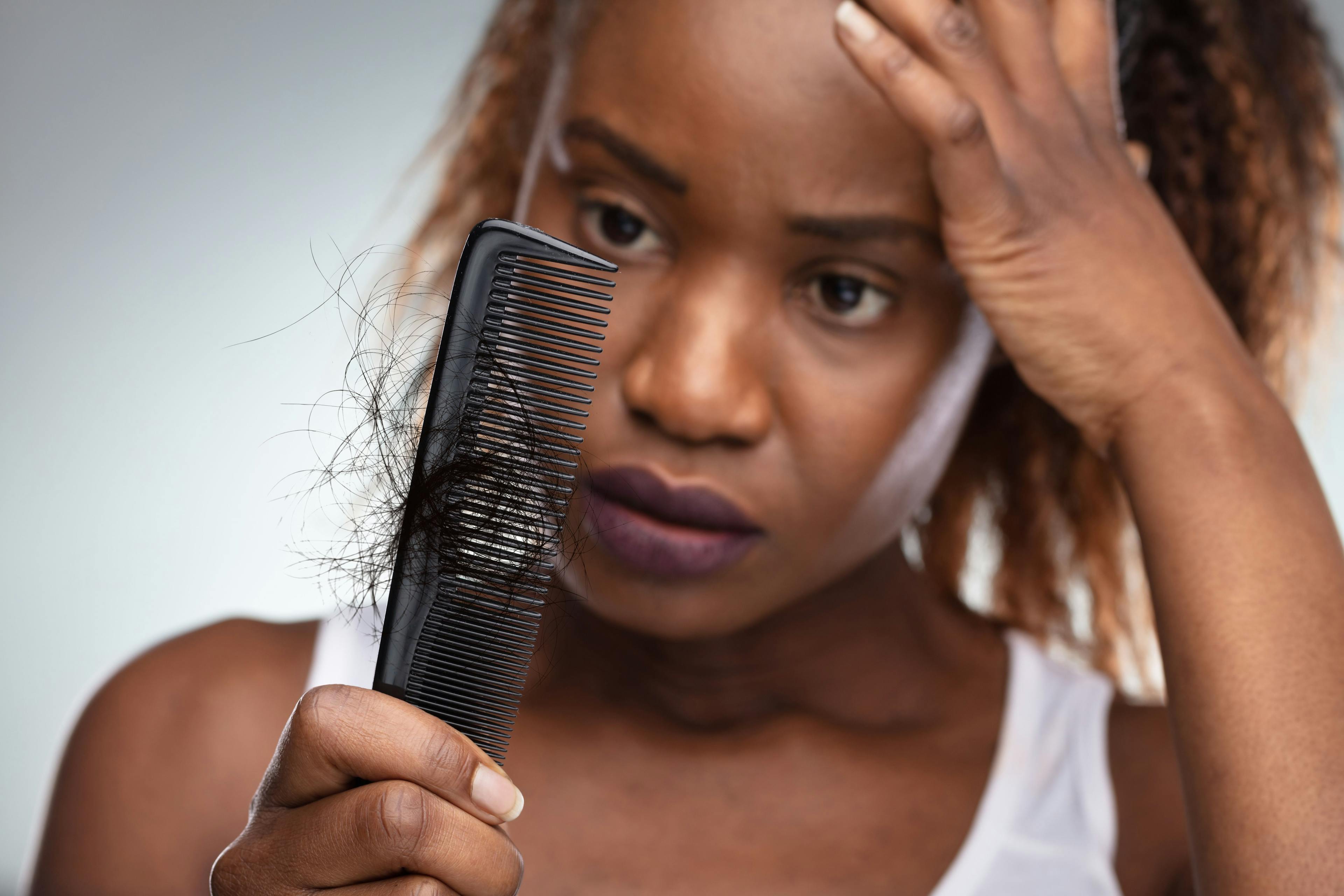 Top 8 Hair Loss Articles 