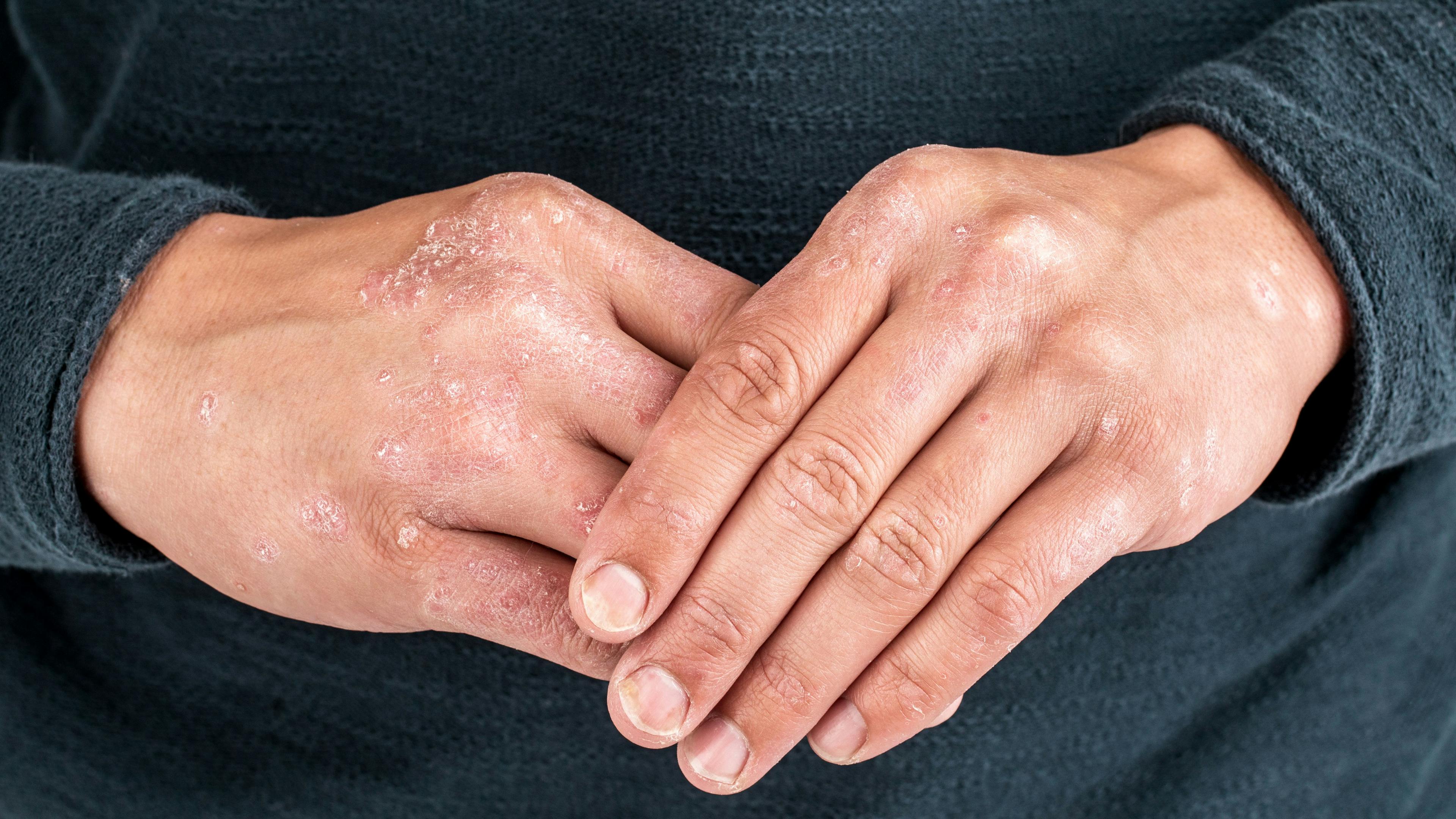 Soligenix Expands Synthetic Hypericin Psoriasis Study