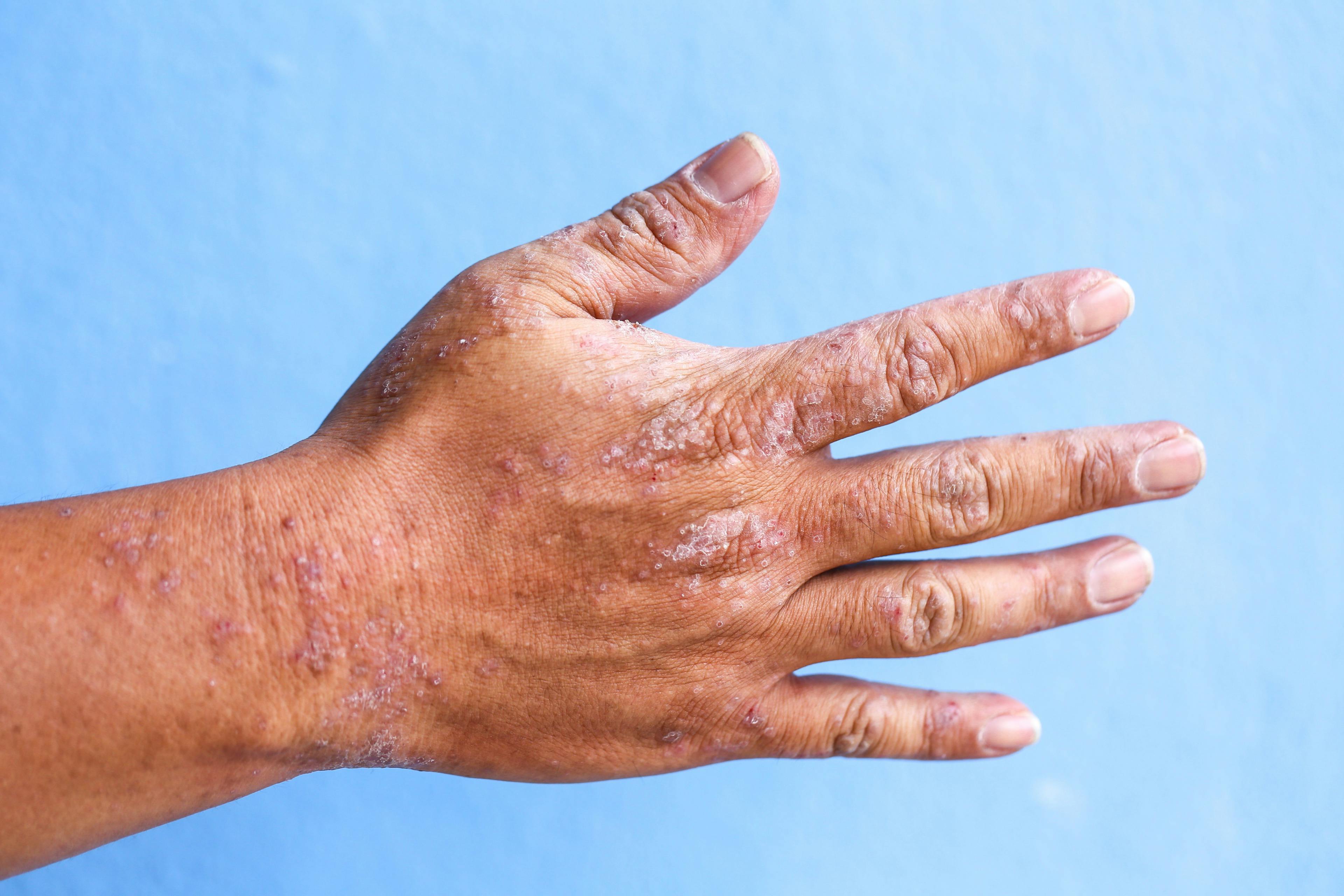 South Korea Study Delves Into Safety Insights for JAK Inhibitors for Atopic Dermatitis