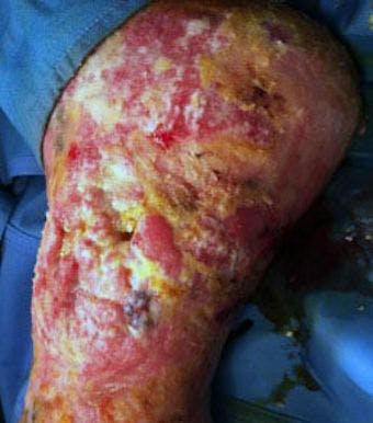 Leg ulcers that require punch biopsies