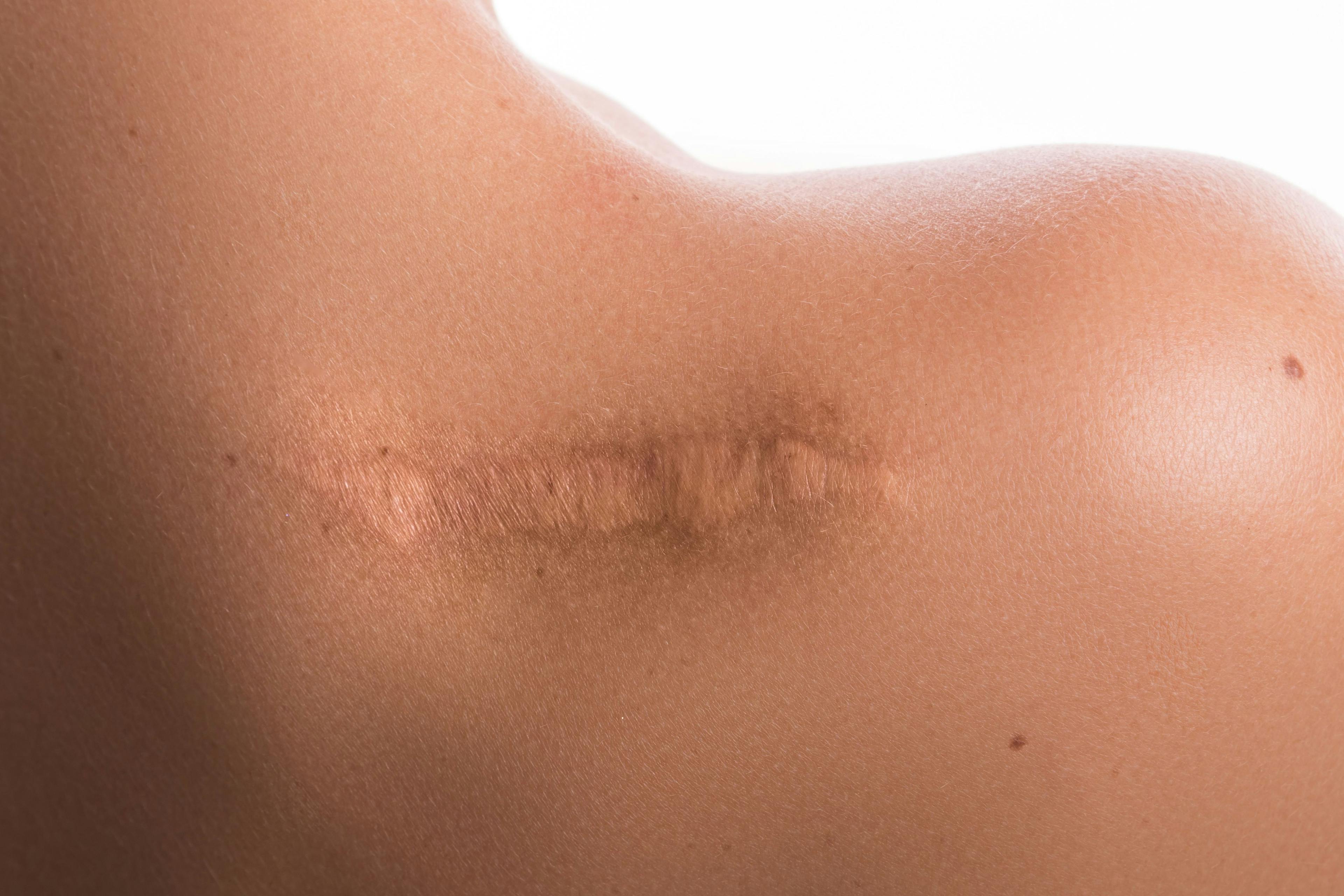 Preventing Keloid Recurrence With SRT 