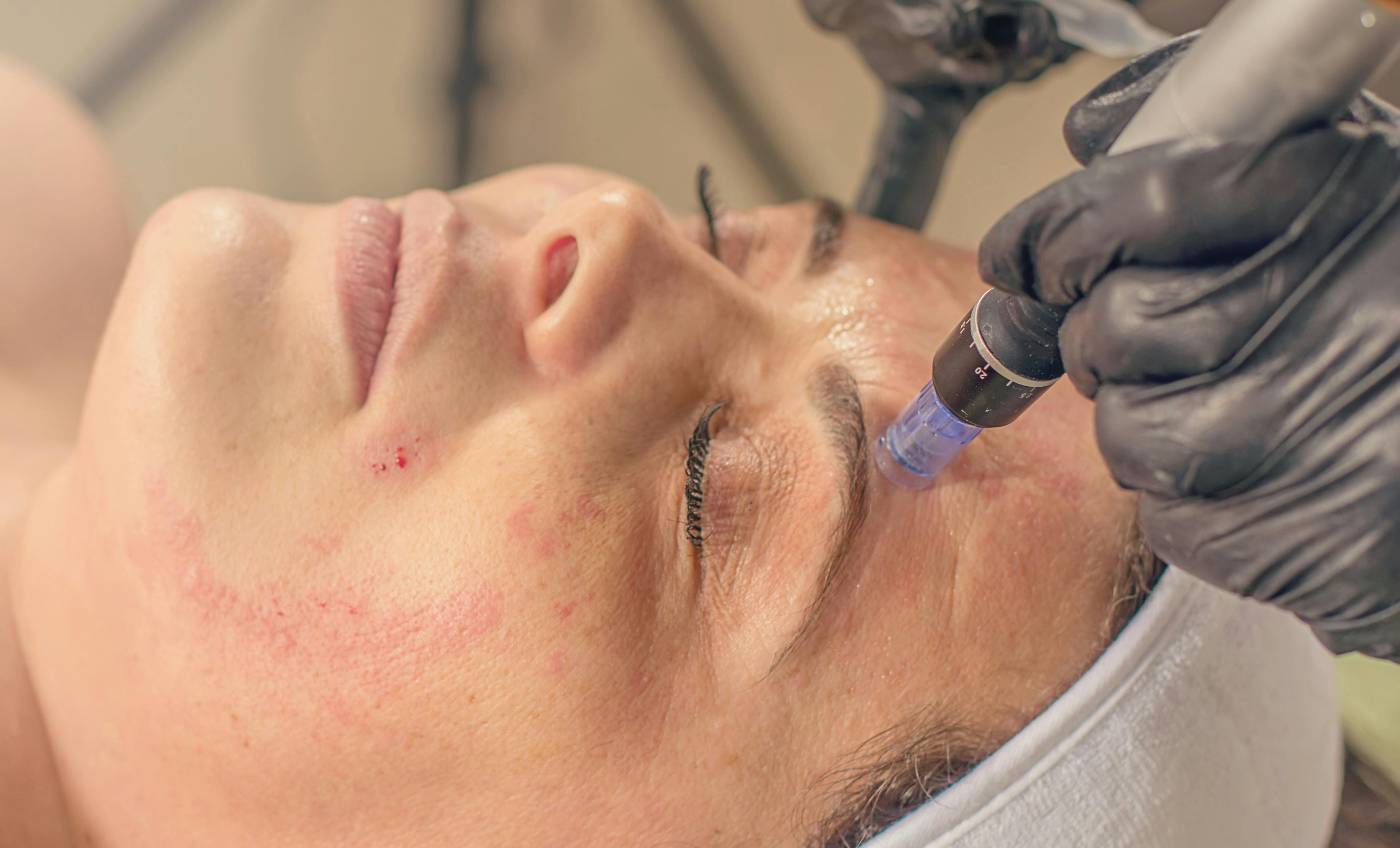 Microneedling improves acne scars, hyperpigmentation in skin of color