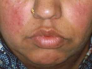 Elevated Plasma Calcitonin Gene-Related Peptide Levels in Patients With Rosacea May Open Door for New Therapeutic Approaches