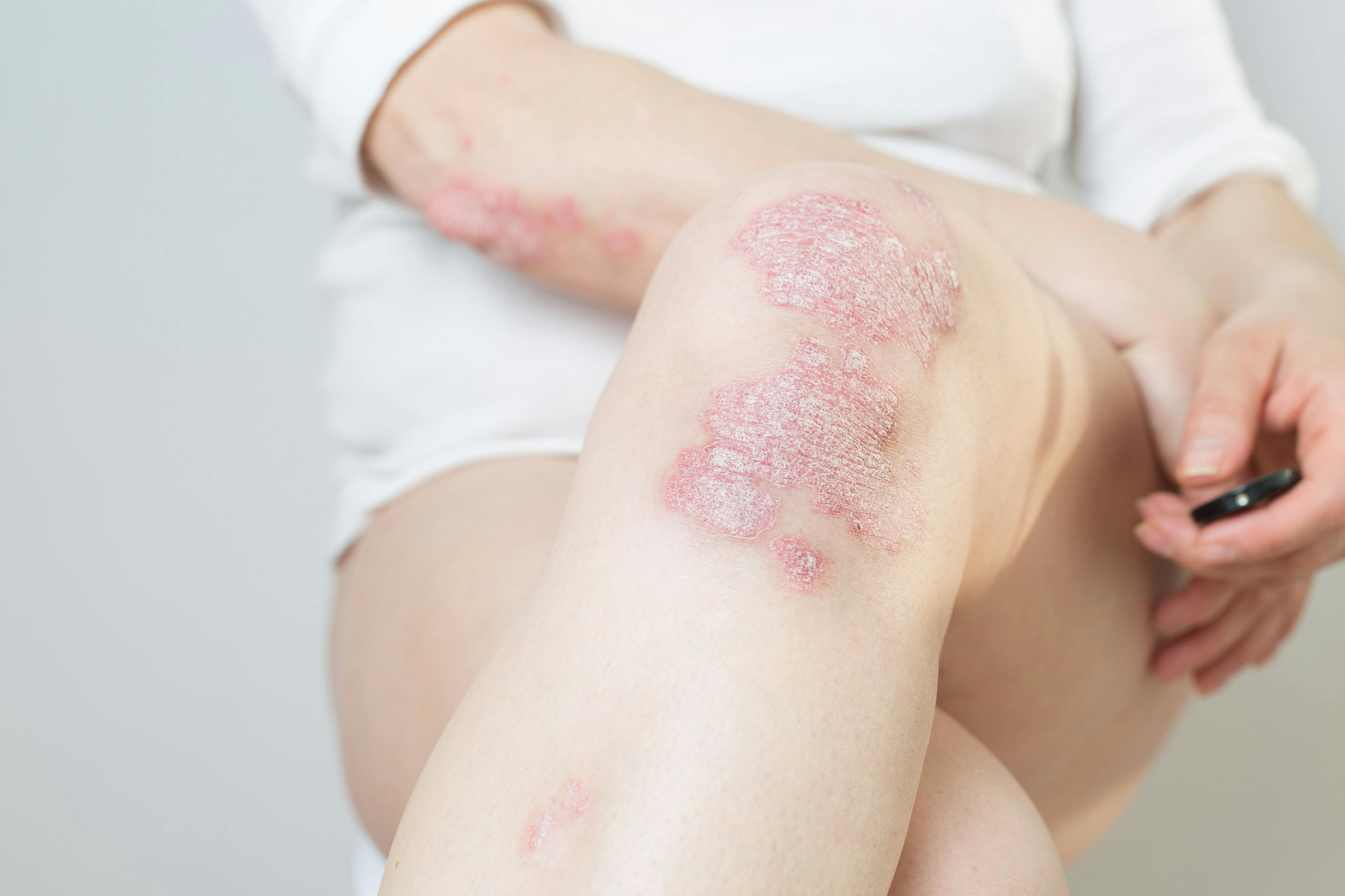 Woman with psoriasis plaques on the knees sits cross-legged.