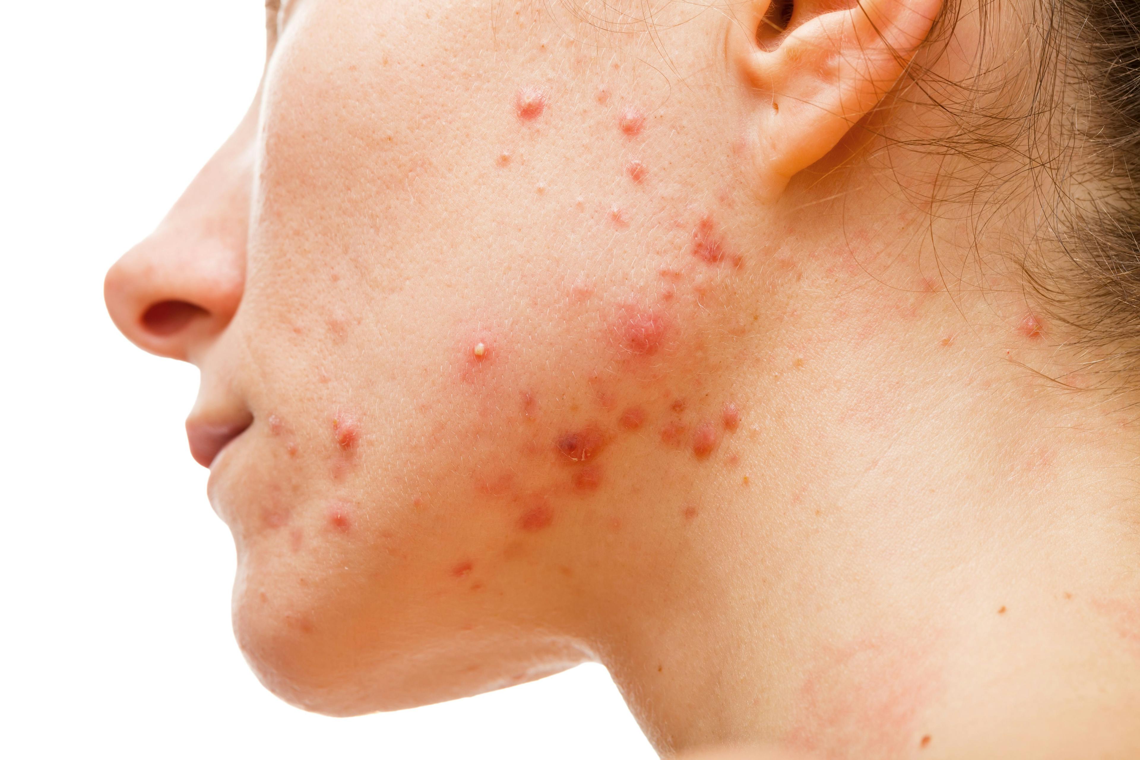 inflamed, red acne lesions on jawline