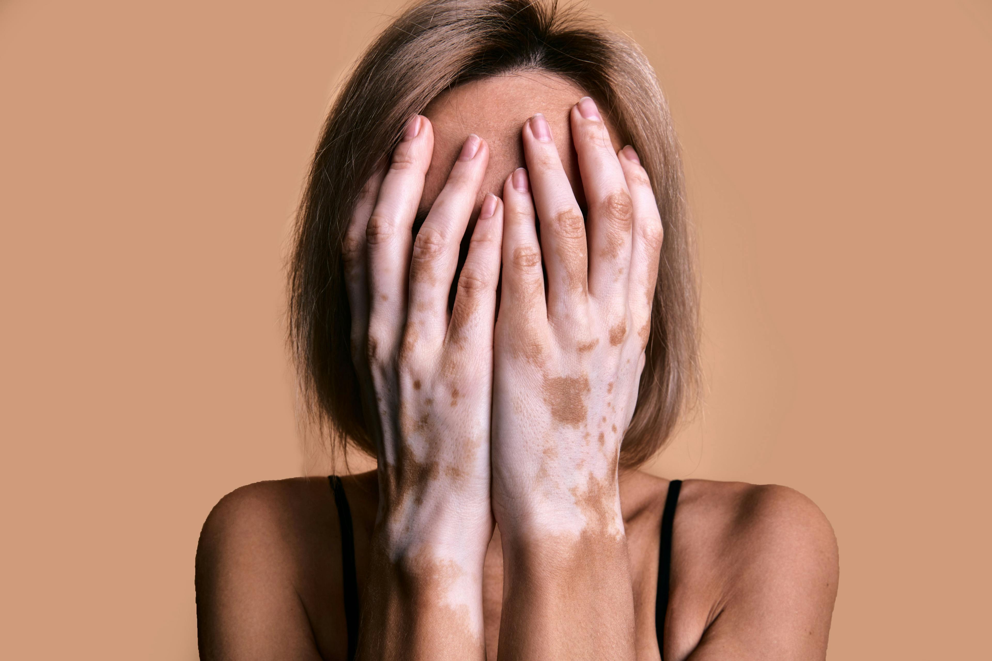 Treatment of Vitiligo with Phototherapy