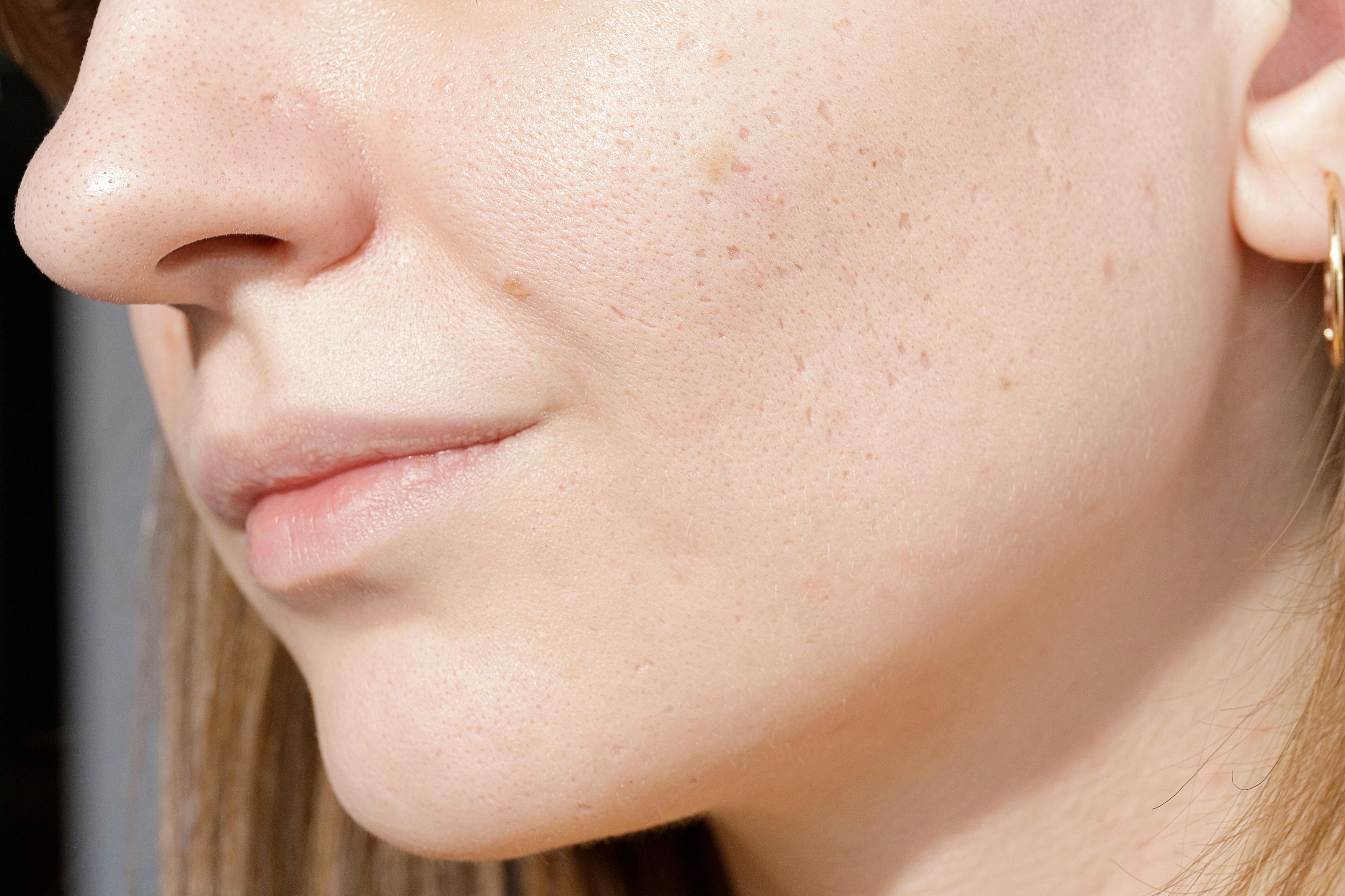 Fractional Picosecond Laser is an Effective Treatment For Atrophic Acne Scars