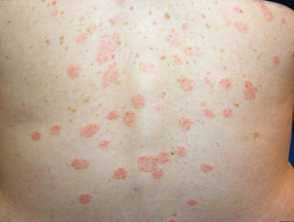 COVID-19 Vaccination May Increase Risk of Pityriasis Rosea, Similar Eruptions