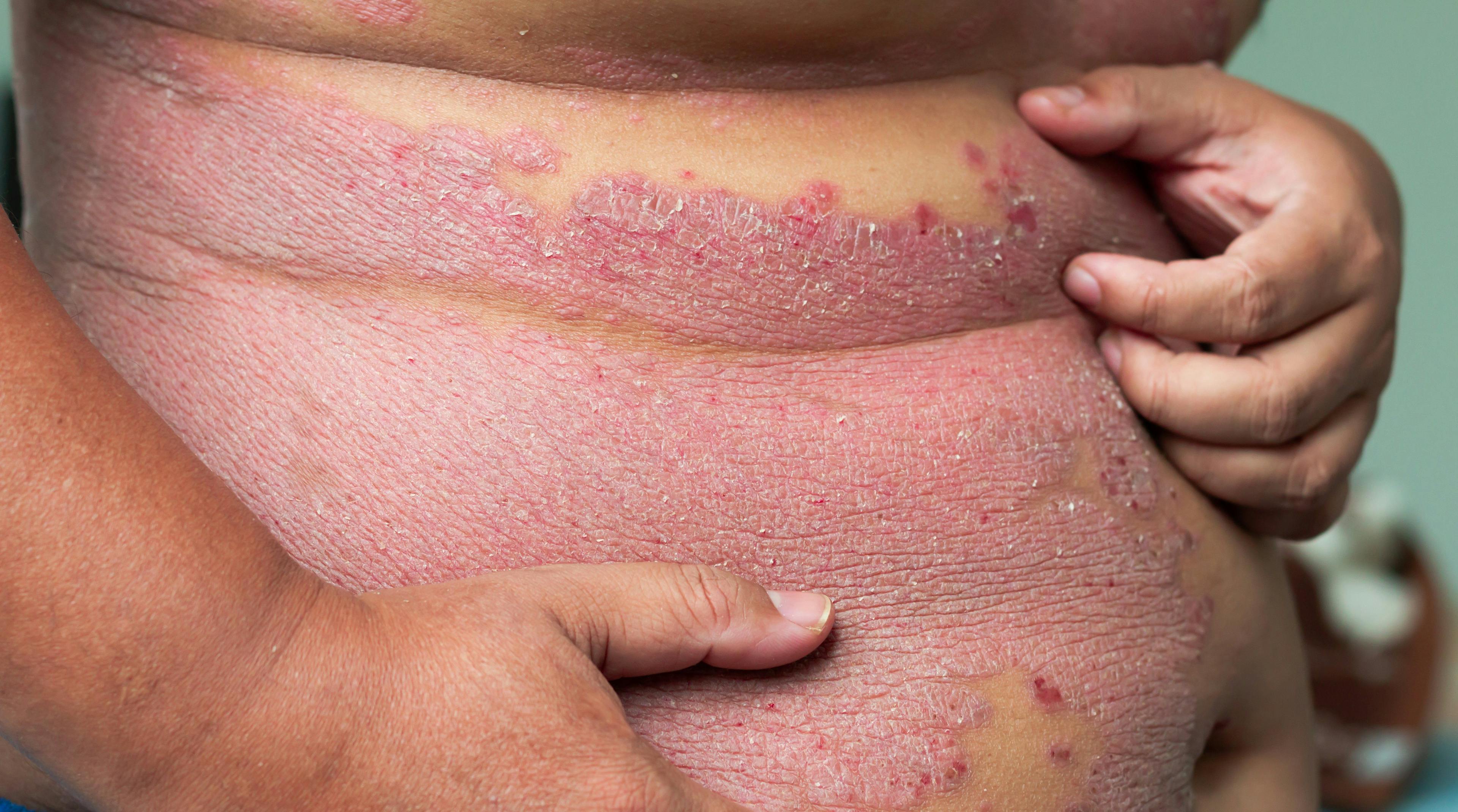 Fatty liver disease first in psoriasis