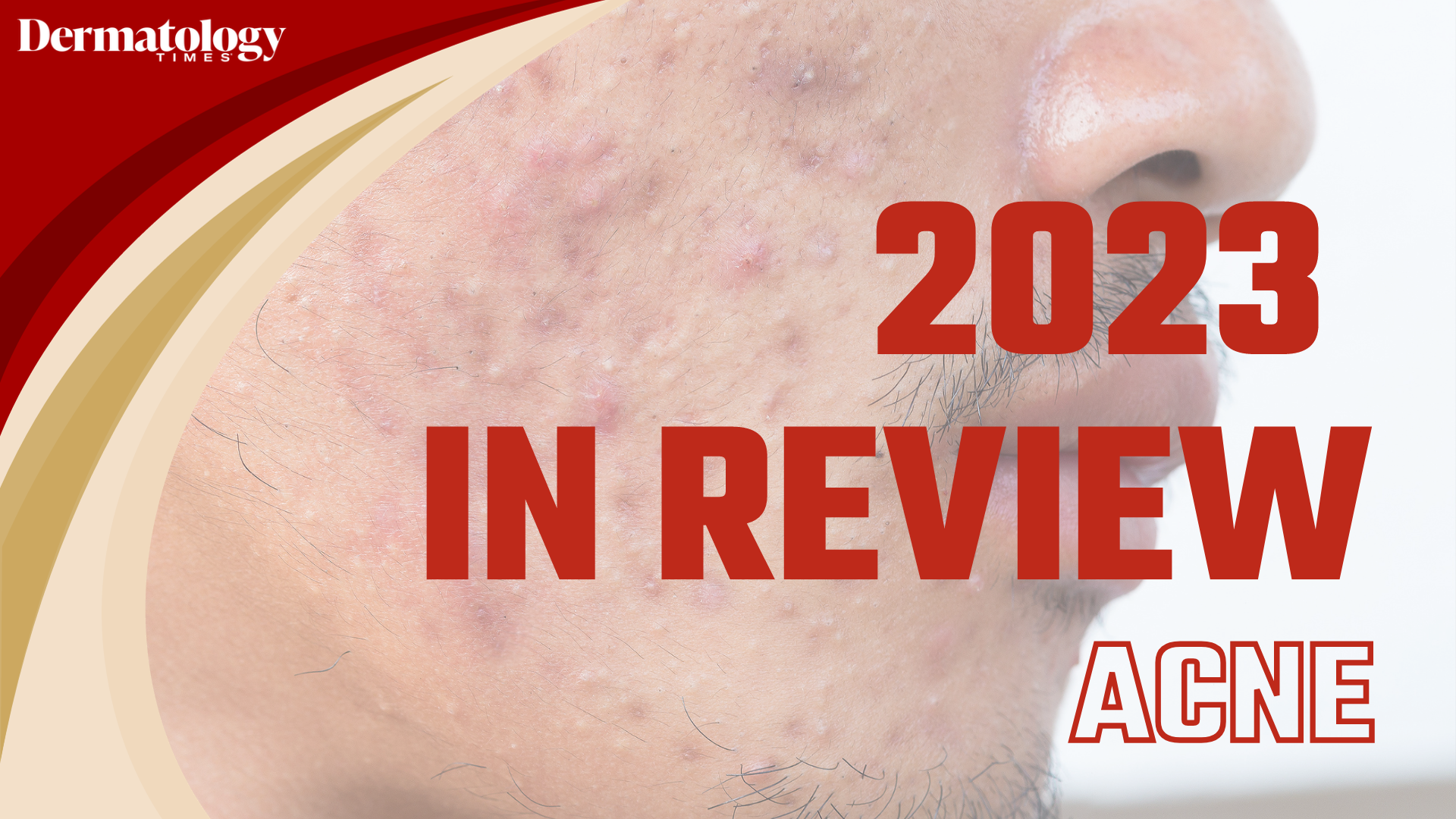Dermatology Times 2023 In Review: Acne