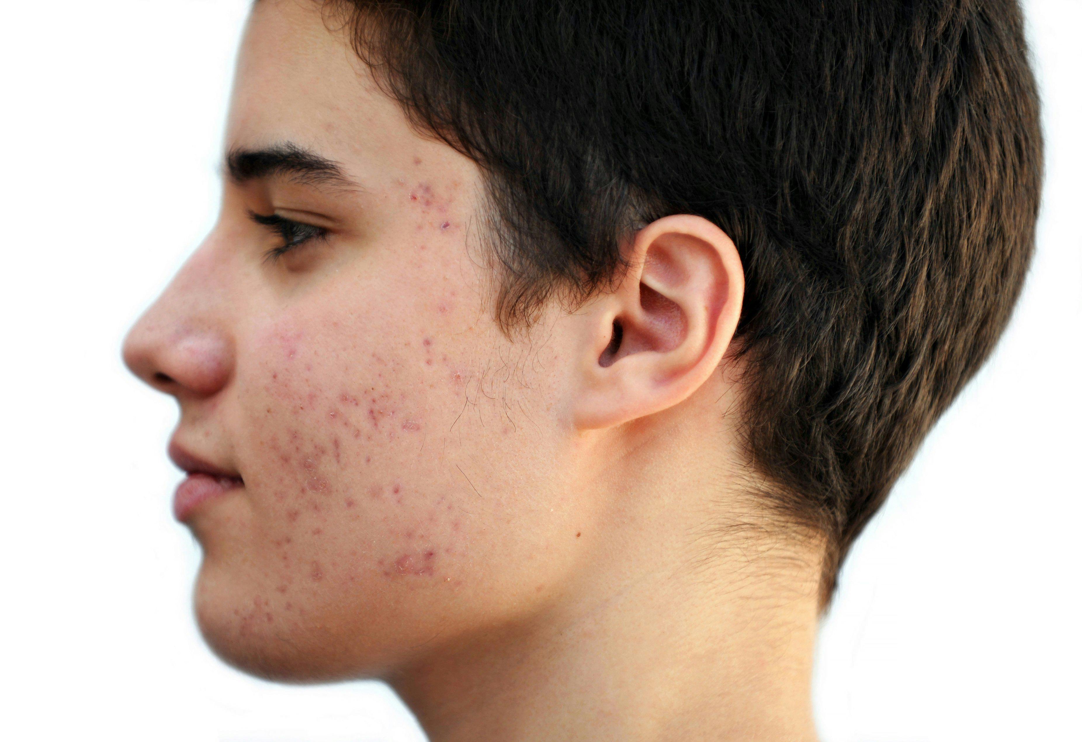 new acne treatments 