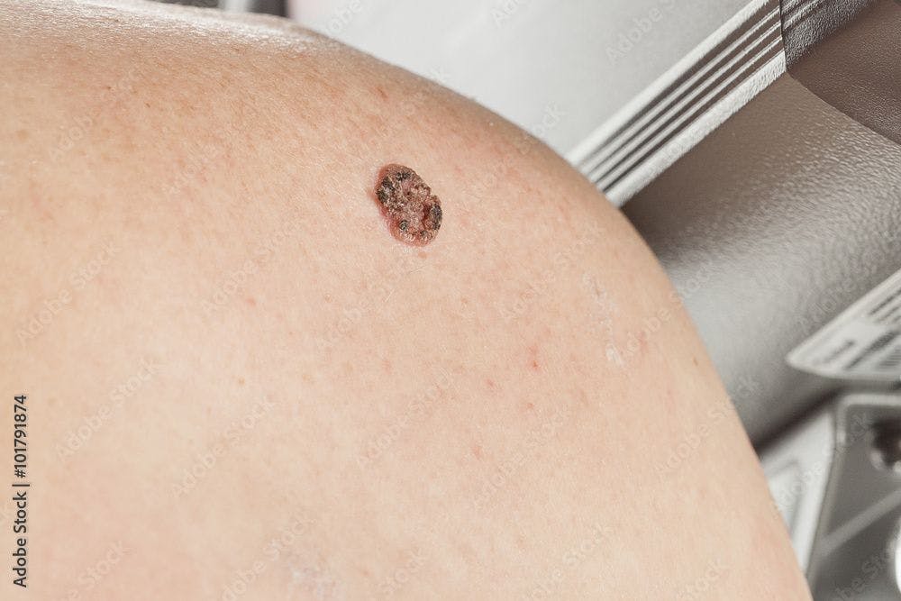 FDA Clears DermaSensor Device for Skin Cancer Detection