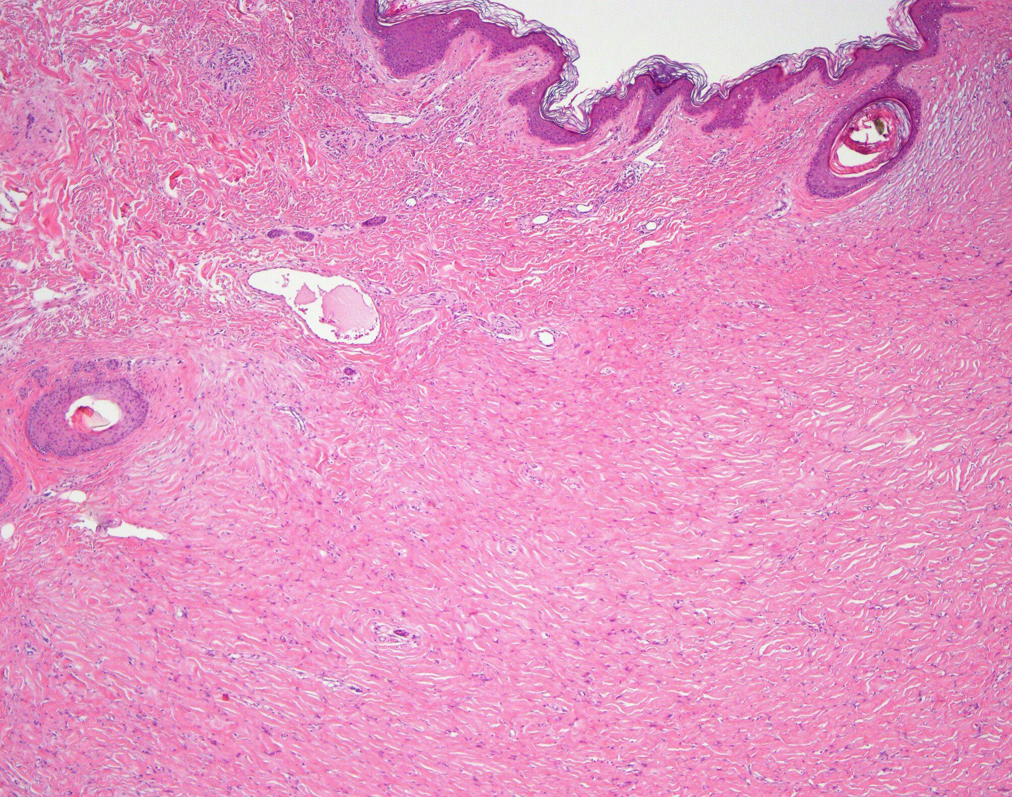 Case Study Reports Multiple Giant Cell Collagenomas Associated With Cowden Syndrome