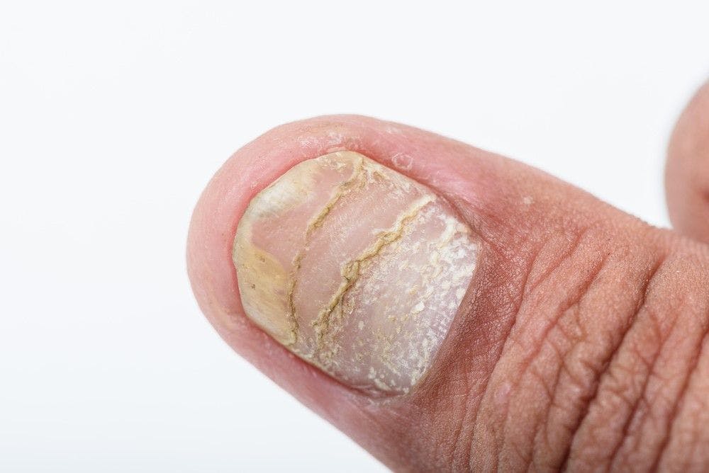 Fingernail Psoriasis 1 (©SweetheartStudioShutterstock.com)