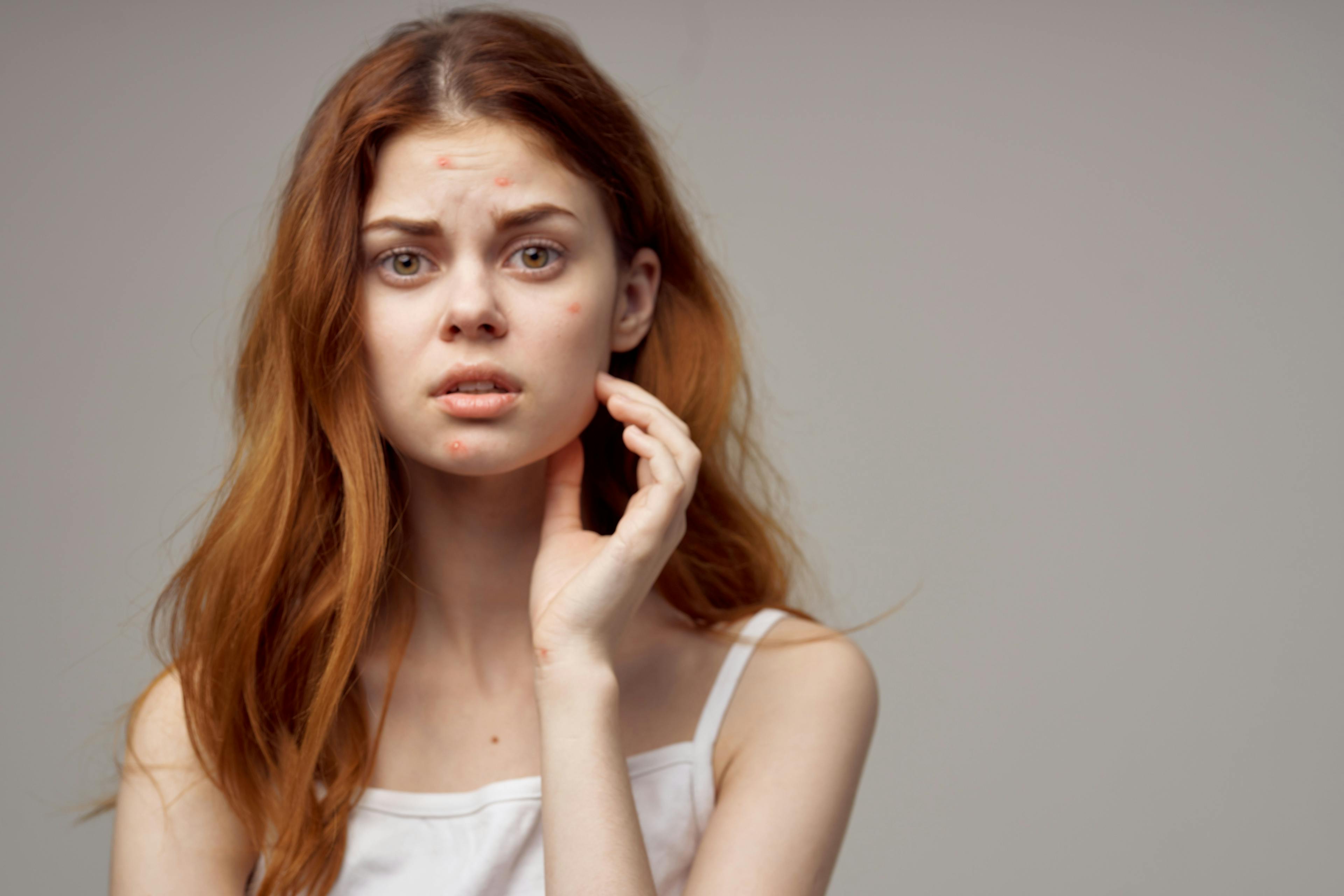 Acne vulgaris in teenagers