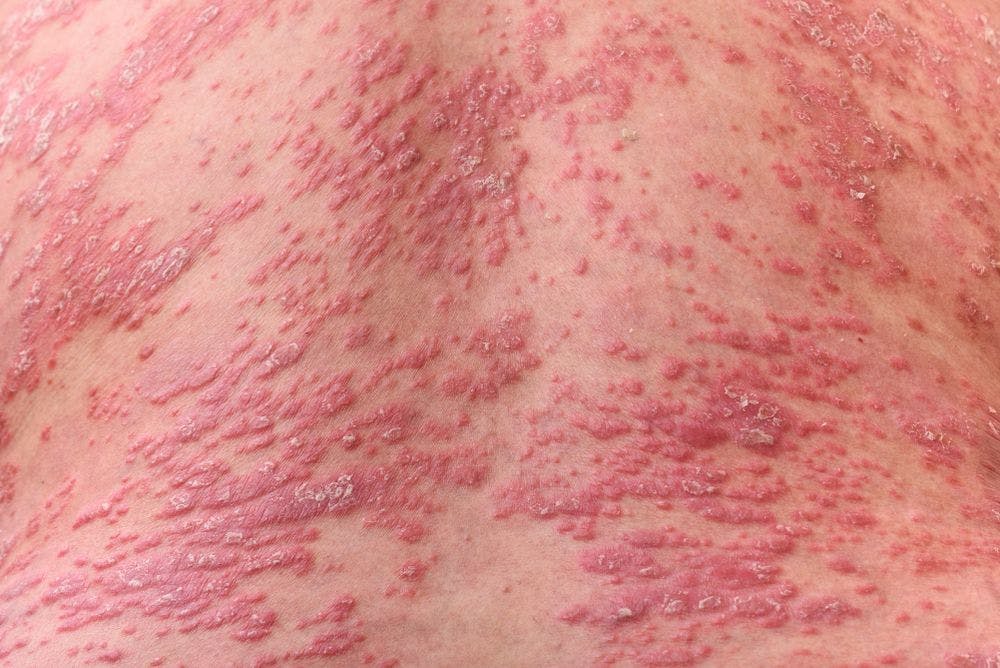 Stop and re-start biologics are tricky in psoriasis