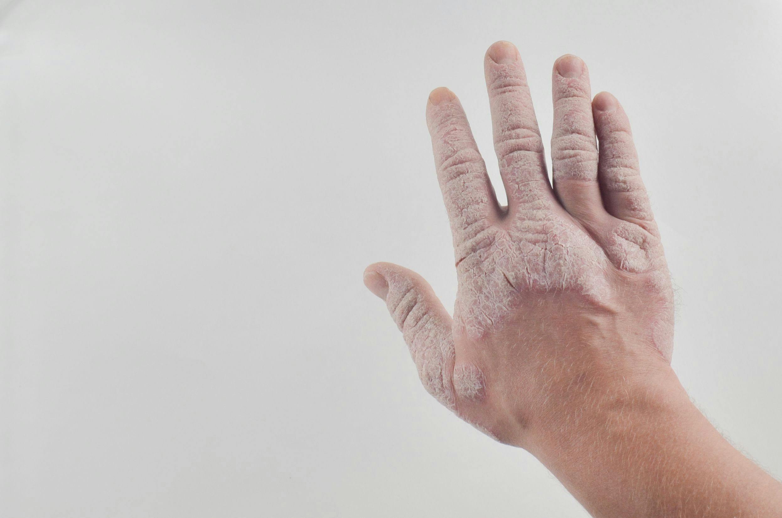 FDA approves guselkumab for psoriatic arthritis