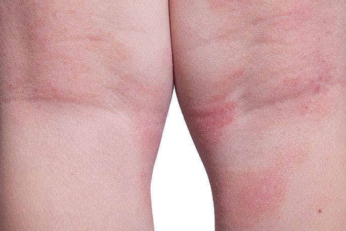 child with atopic dermatitis on back of knees