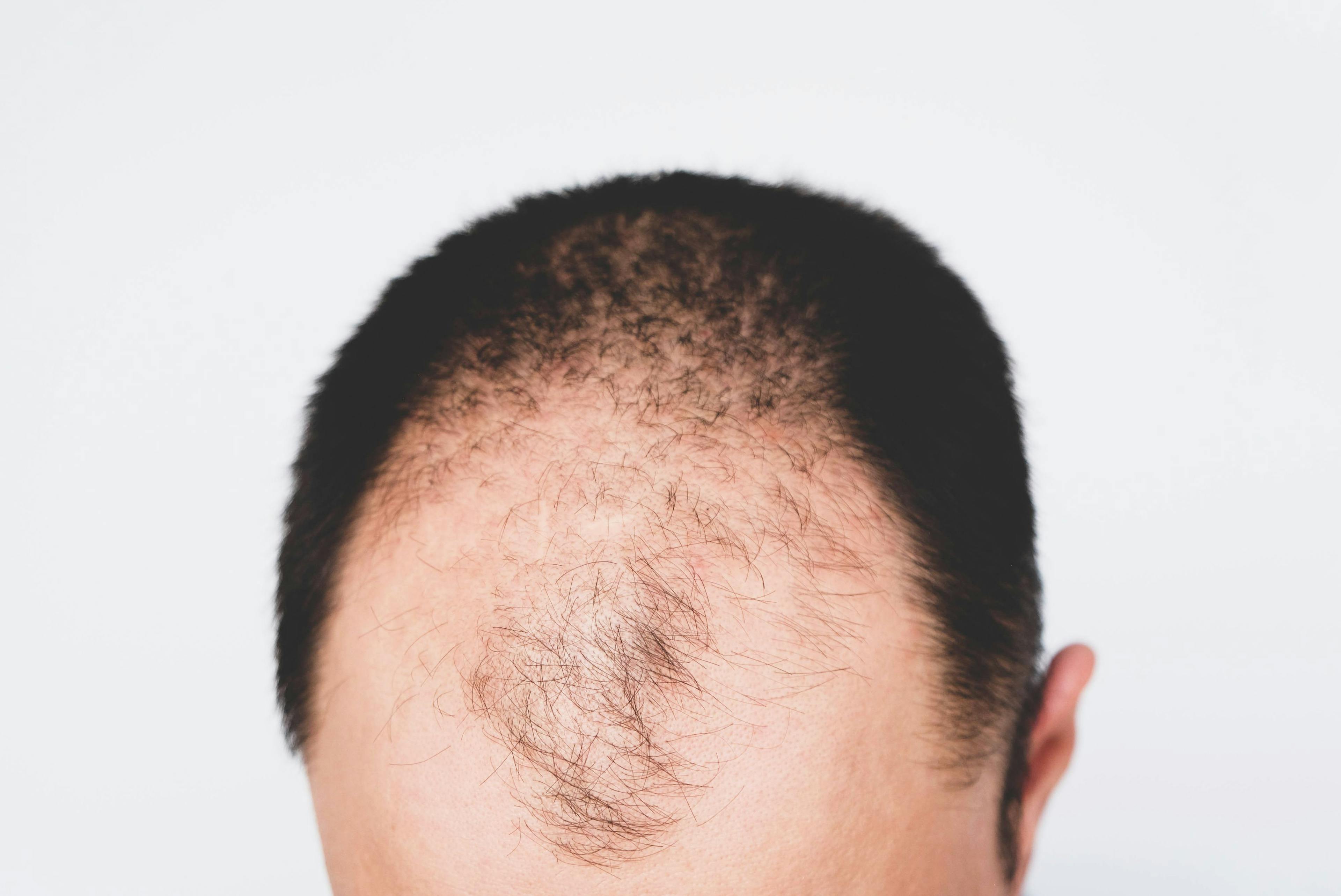 Finasteride and Hydroxychloroquine Deemed Equally Effective in Treatment of Frontal Fibrosing Alopecia