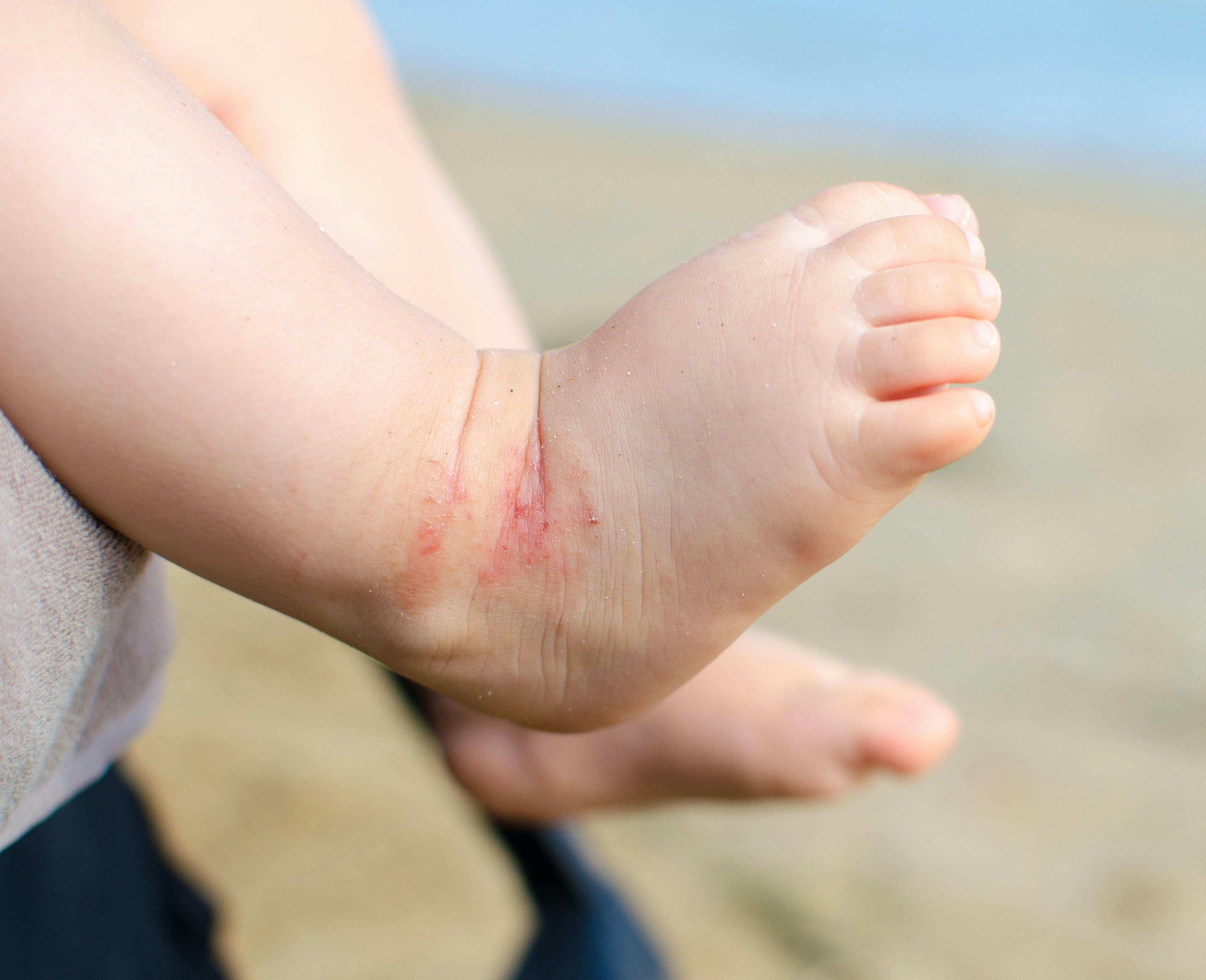pediatric atopic dermatitis on foot.