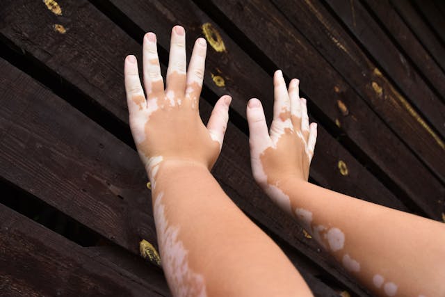 Experts Develop Evidence and Consensus-Based Recommendations for Diagnosing and Treating Vitiligo in Young Patients