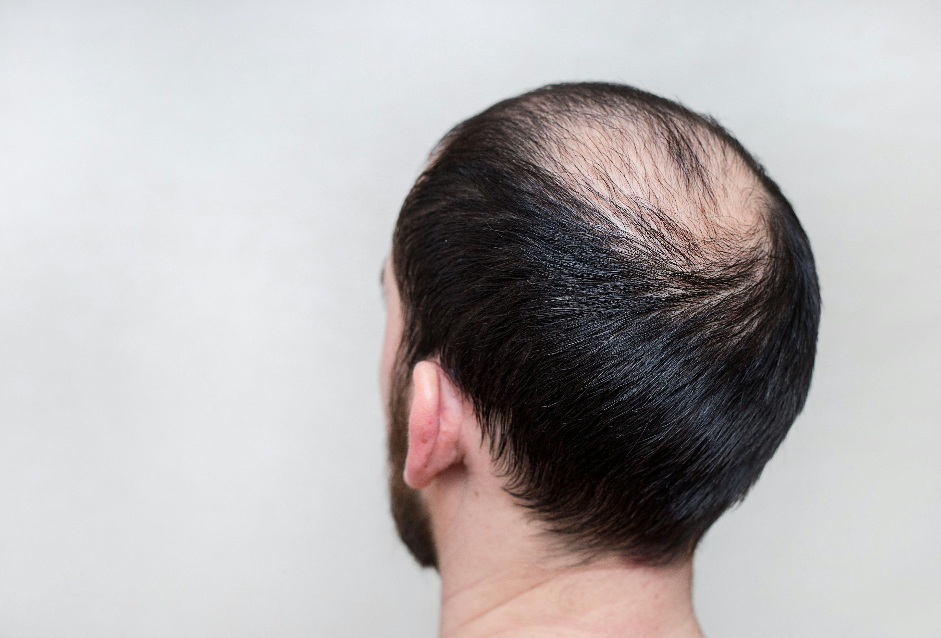 Antihistamines effective in alopecia areata study