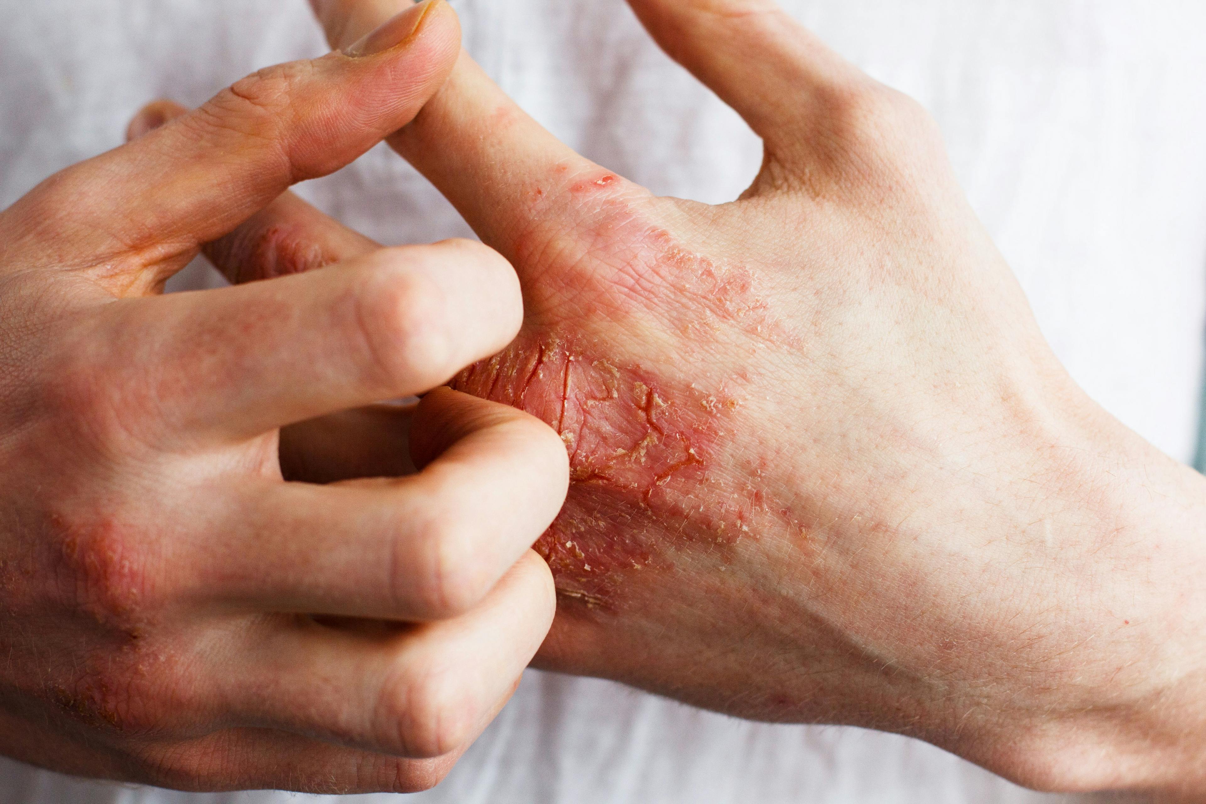 The Latest Buzz on Psoriasis