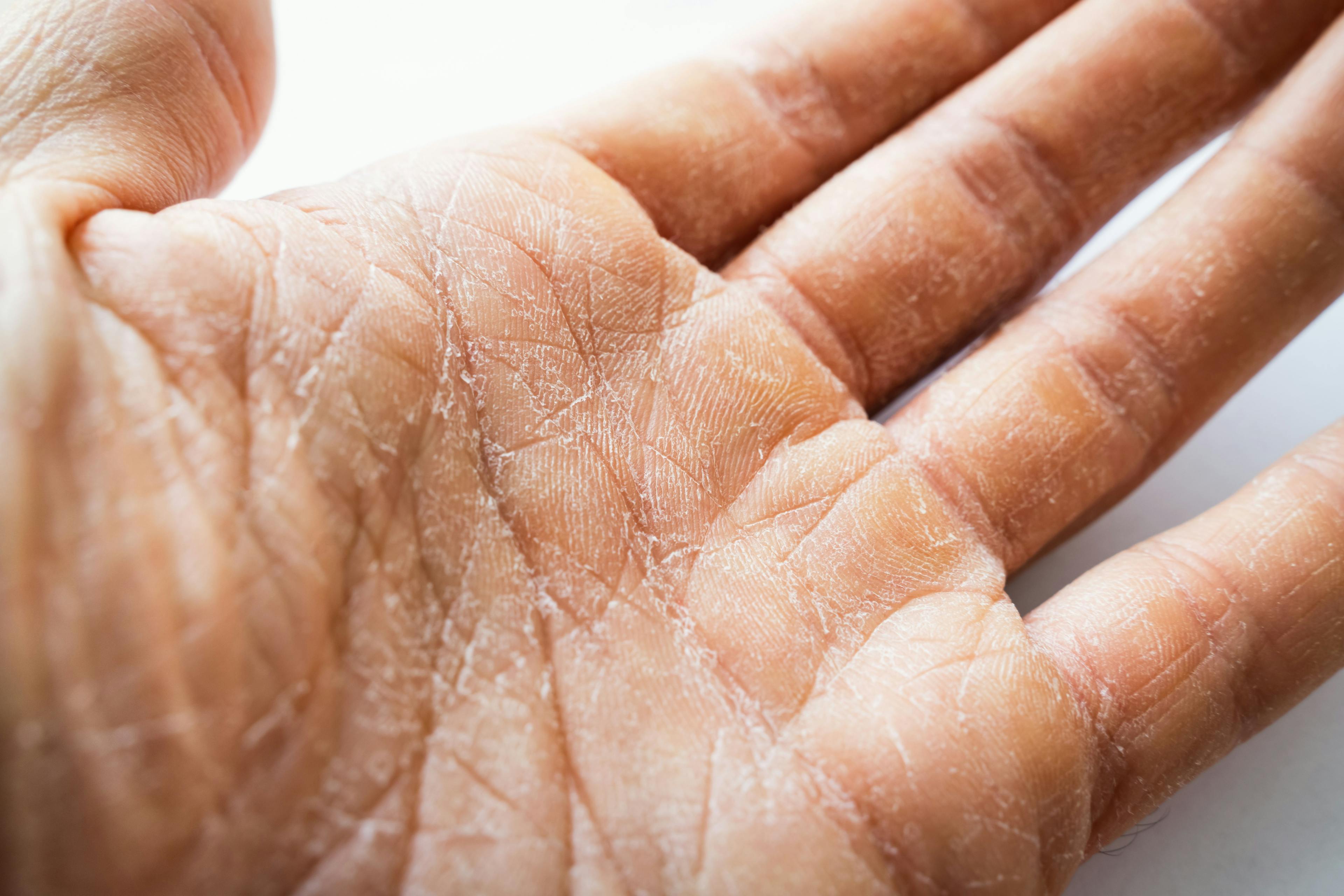 GlobalSkin’s GRIDD Study Seeks to Evaluate Global Impact of Skin Diseases
