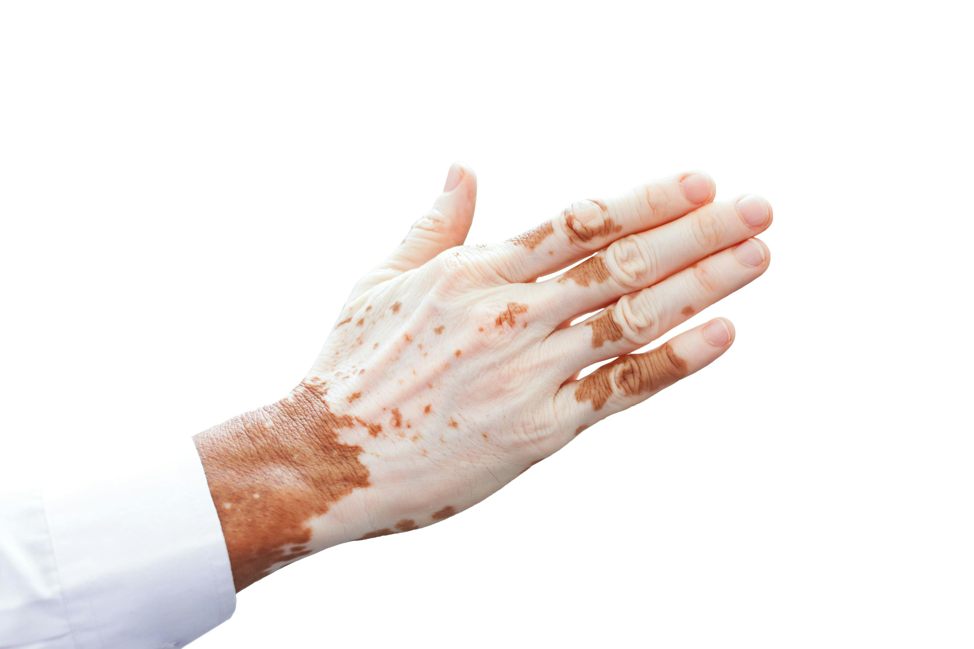 Study: Ruxolitinib Cream in Vitiligo