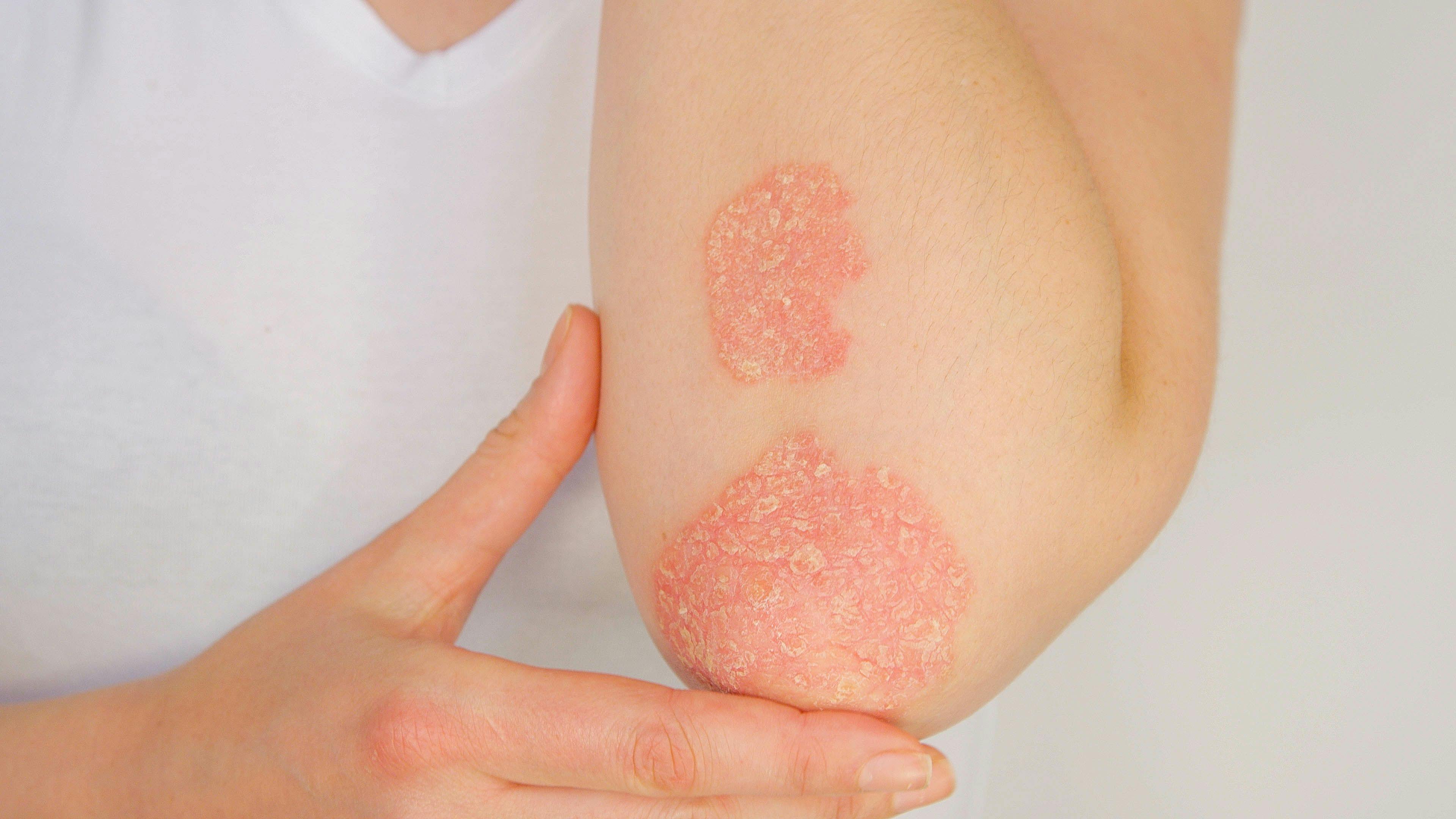 Systemic psoriasis therapies not age-dependent