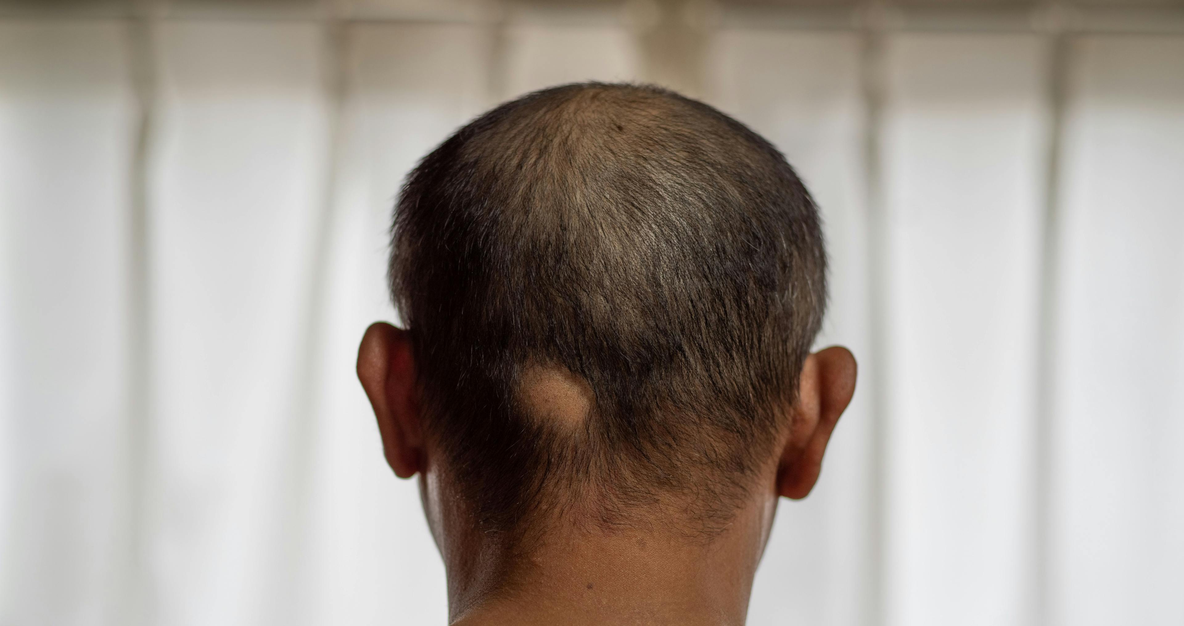 Several Barriers Linked to Hindered Access of JAKi Therapy in Patients, Particularly Non-White, With Alopecia Areata