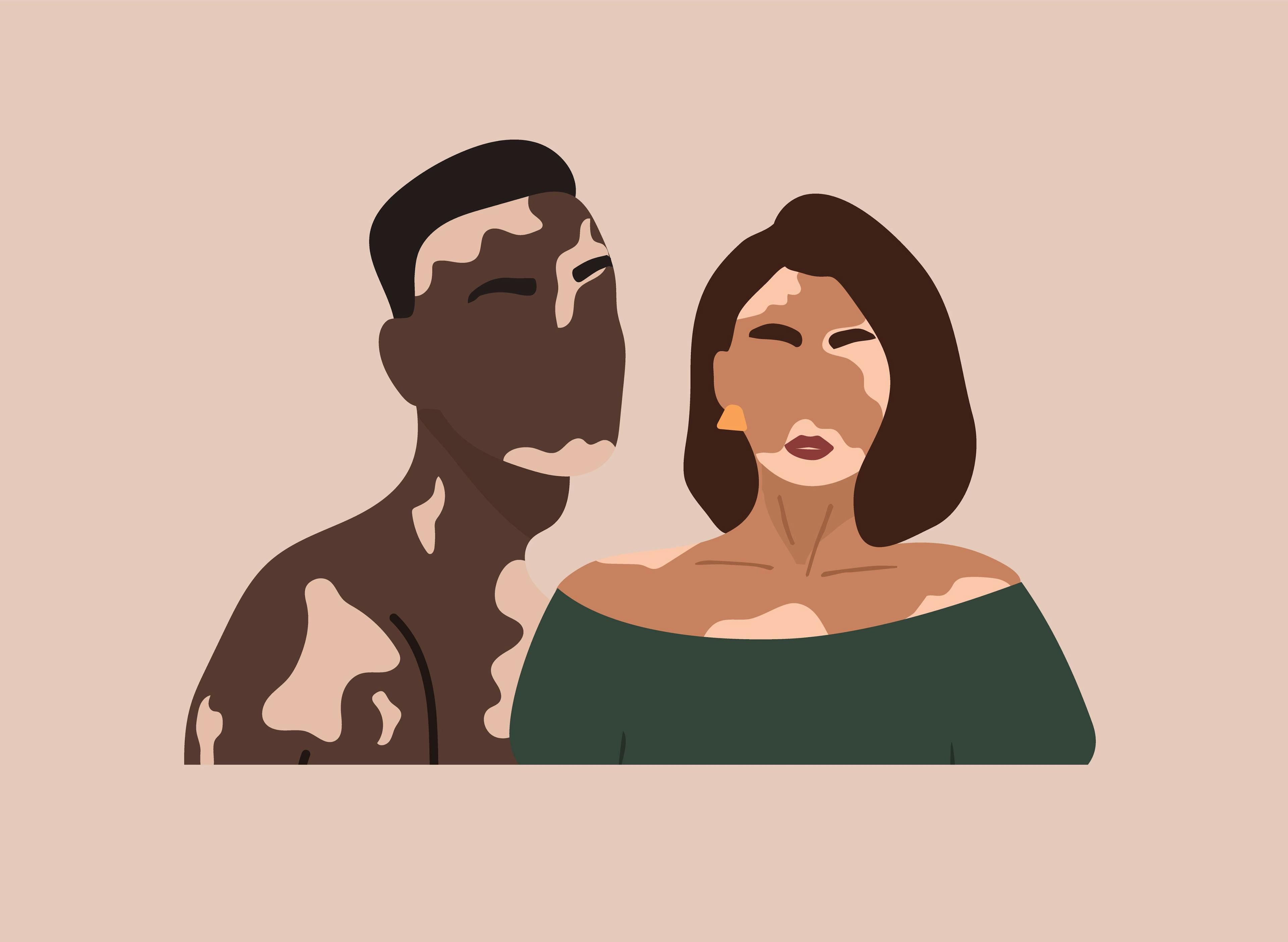 Gender Disparities in Vitiligo: Psychological Effects and QoL 