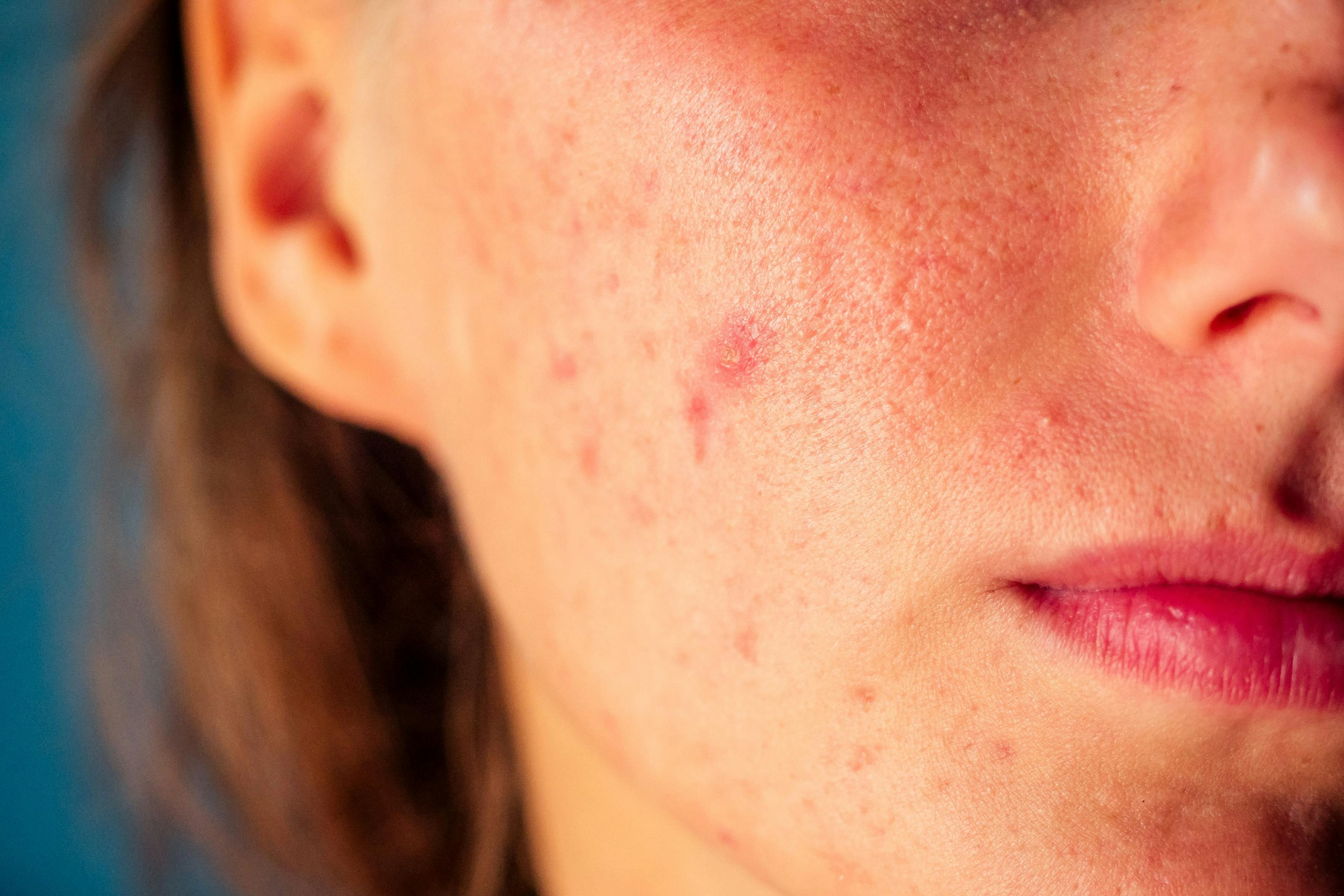 Add-on statins effective in acne